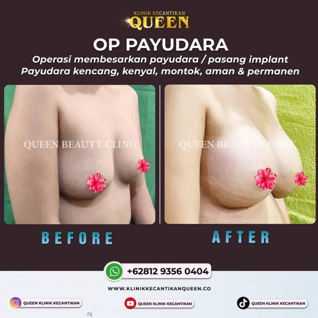 Hasil Breast Implant Queen Plastic Surgery, foto 50