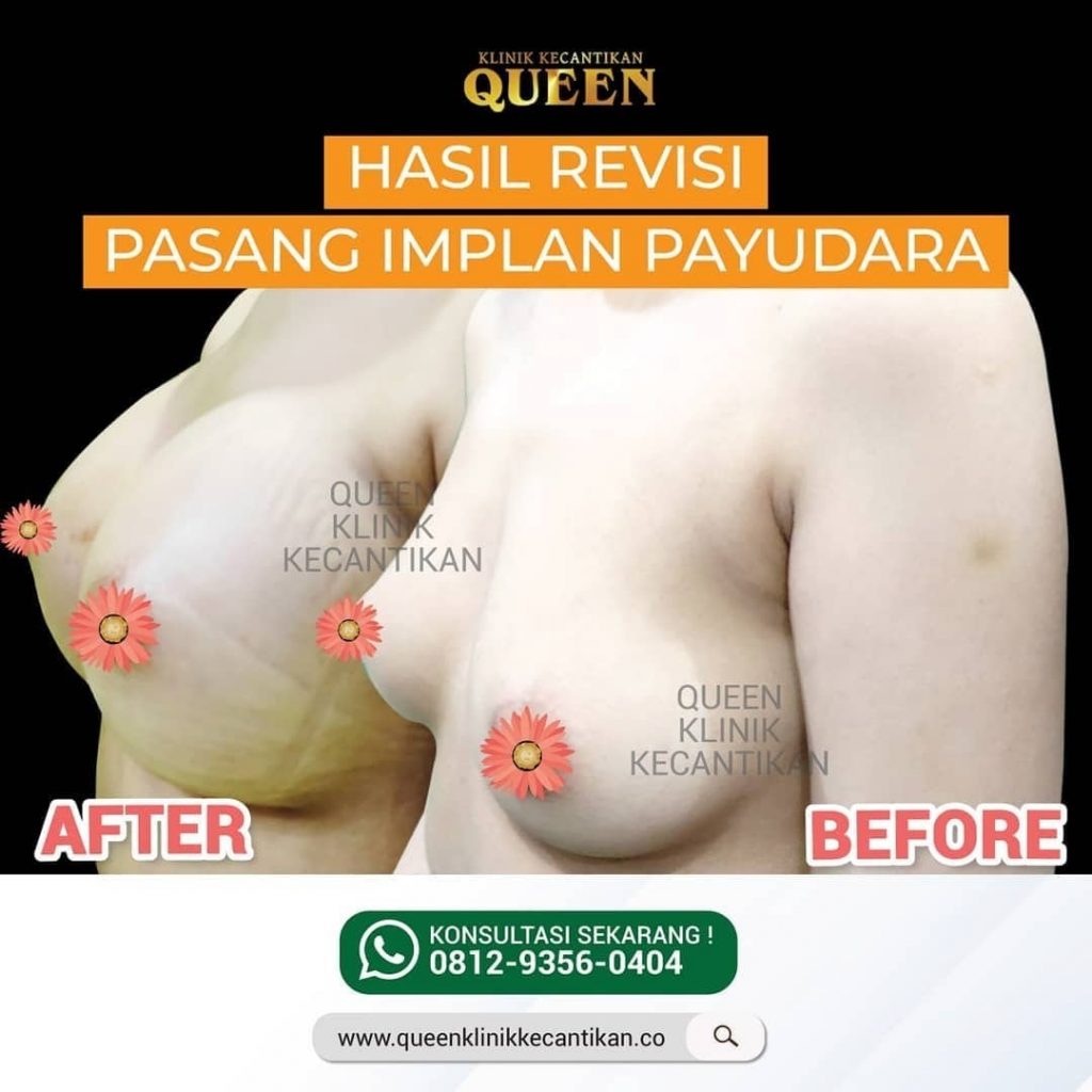 Hasil Breast Implant Queen Plastic Surgery, foto 51
