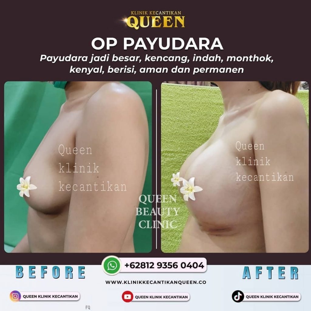 Hasil Breast Implant Queen Plastic Surgery, foto 52