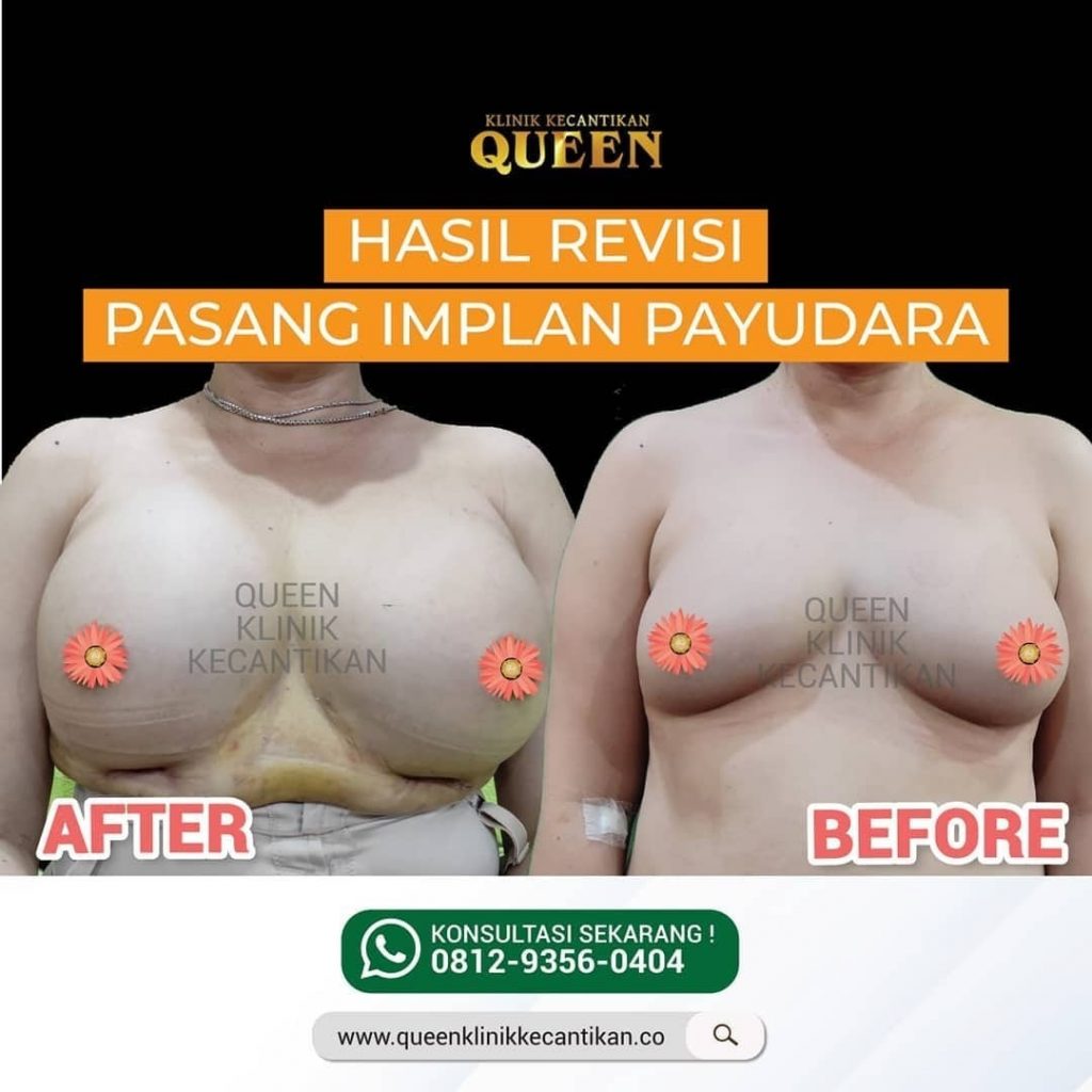 Hasil Breast Implant Queen Plastic Surgery, foto 48