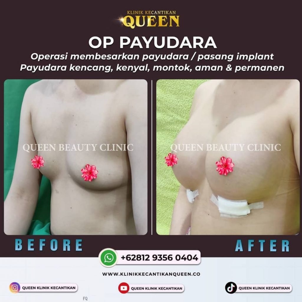 Hasil Breast Implant Queen Plastic Surgery, foto 47