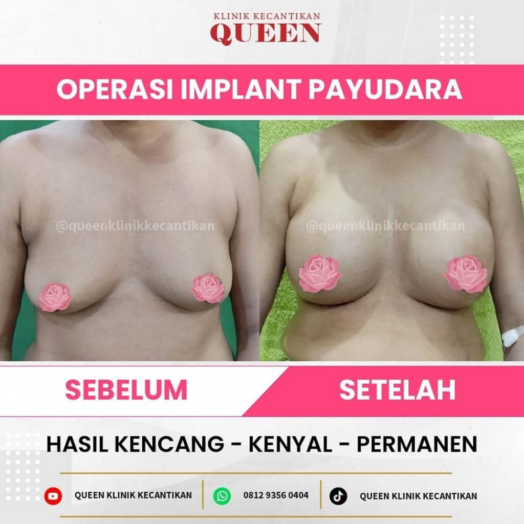 Hasil Breast Implant Queen Plastic Surgery, foto 46