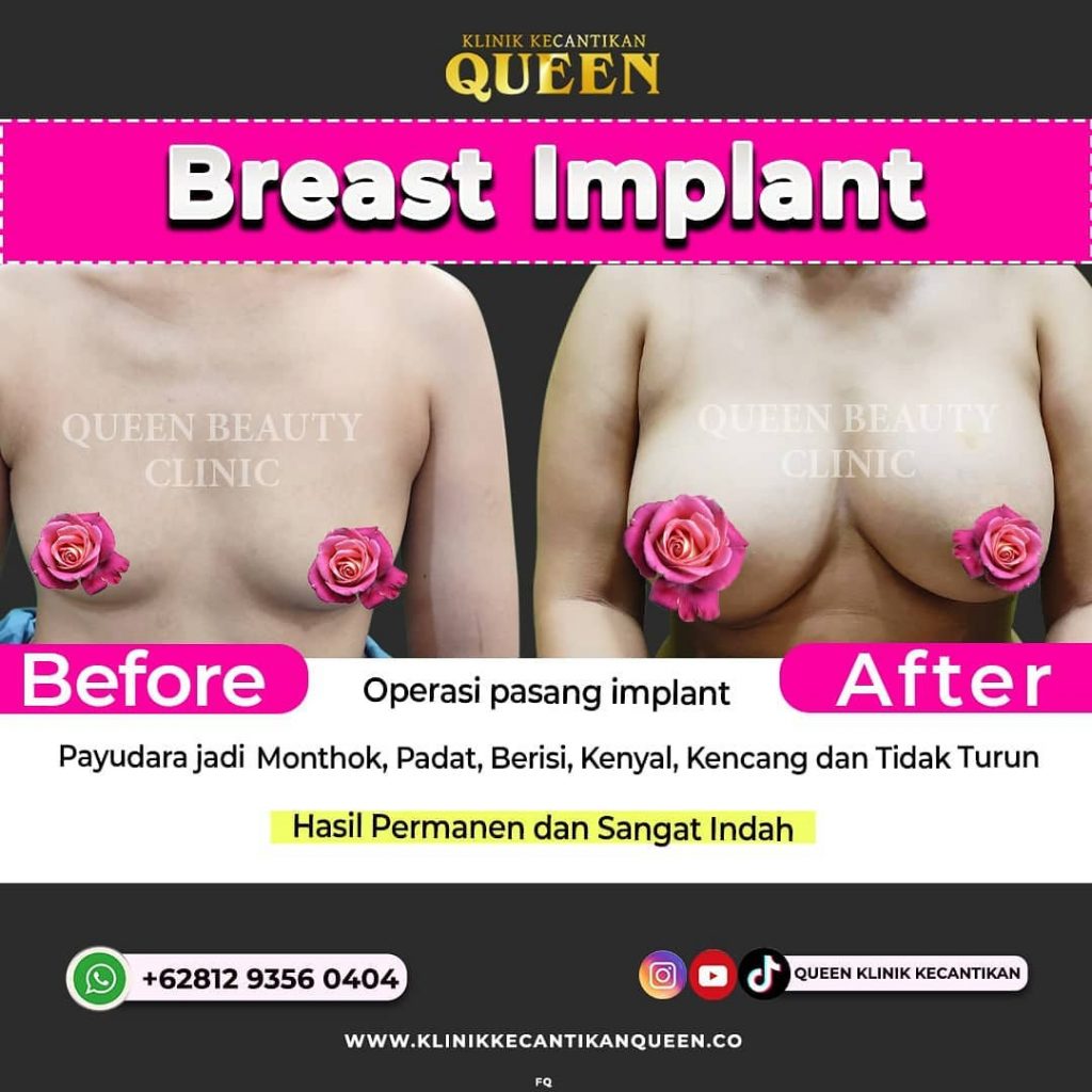 Hasil Breast Implant Queen Plastic Surgery, foto 49