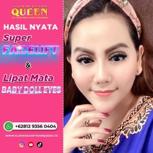 nita-thalia-super-facelift-and-baby-doll-eyes-1