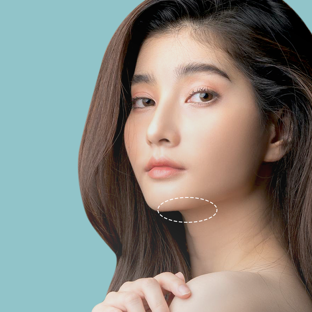 Thread Lift Atau tarik Benang Solusi Double Chin Tanpa Operasi (Part 1)