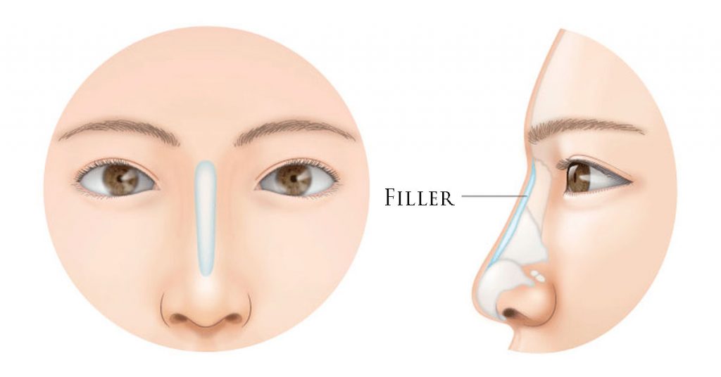 Filler Hidung - Klinik Bedah Plastik Queen