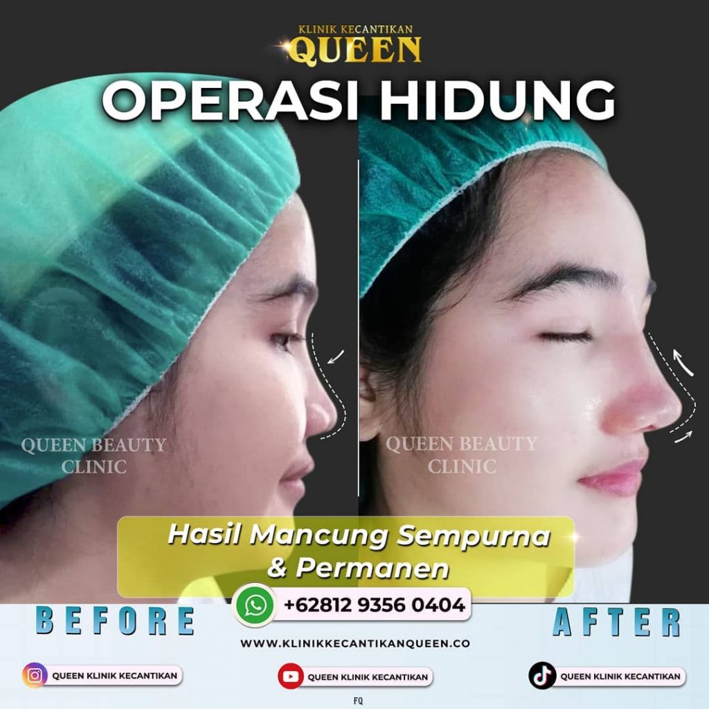 Hasil Rhinoplasty Queen Plastic Surgery, foto 11