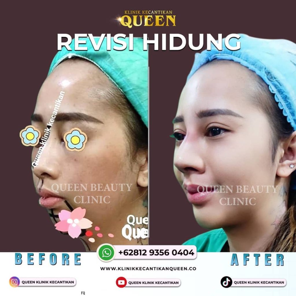 Hasil Rhinoplasty Queen Plastic Surgery, foto 14