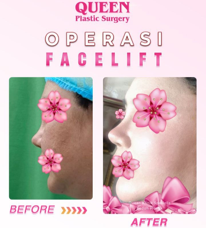 PEMULIHAN PASCA FACELIFT