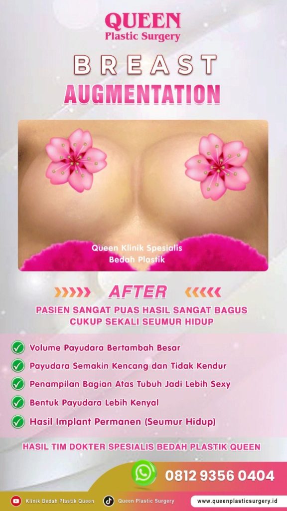 Hasil Breast Implant Queen Plastic Surgery, foto 41