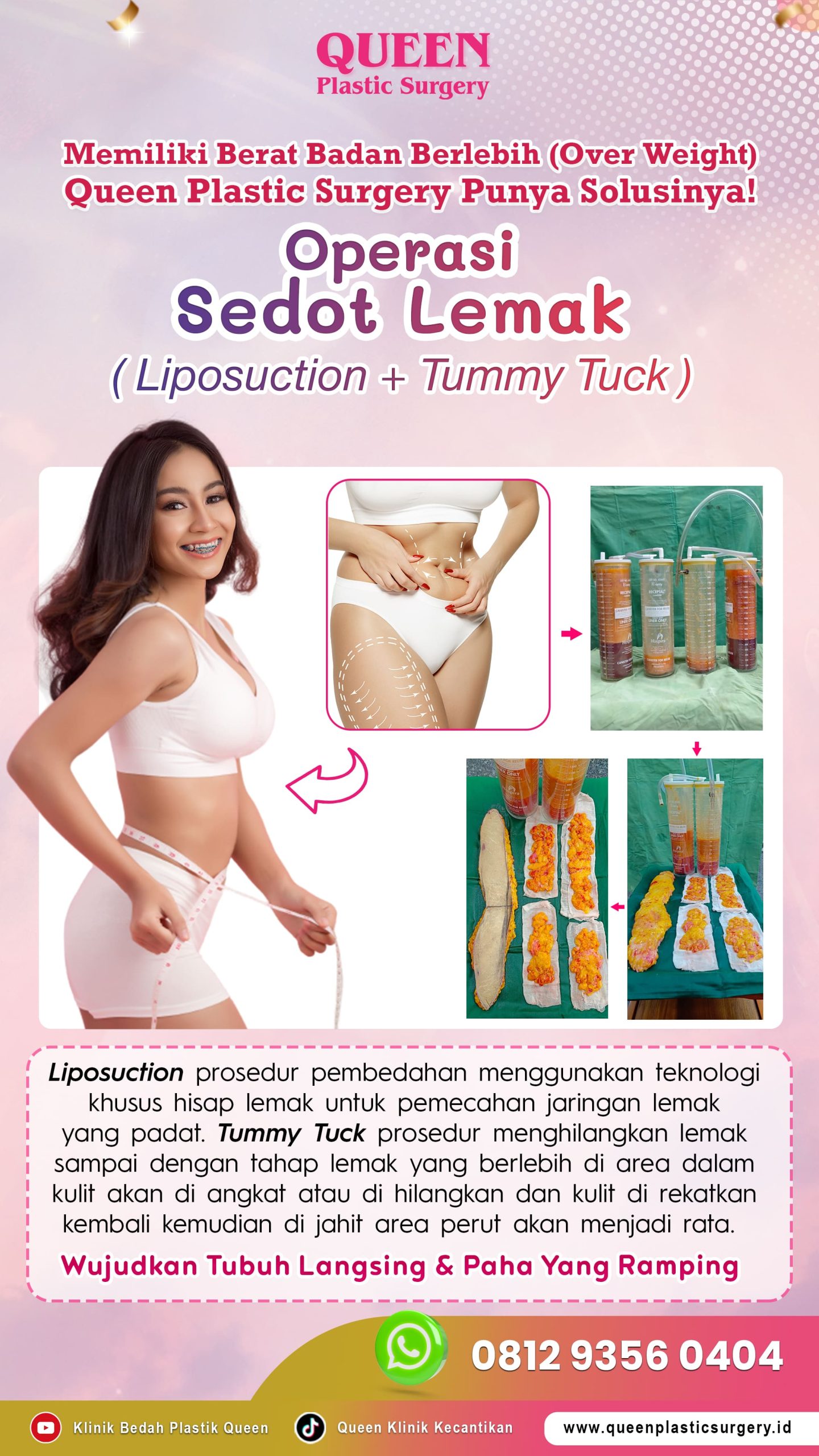 Info-Gambaran-Operasi-Sedot-Lemak-IGS