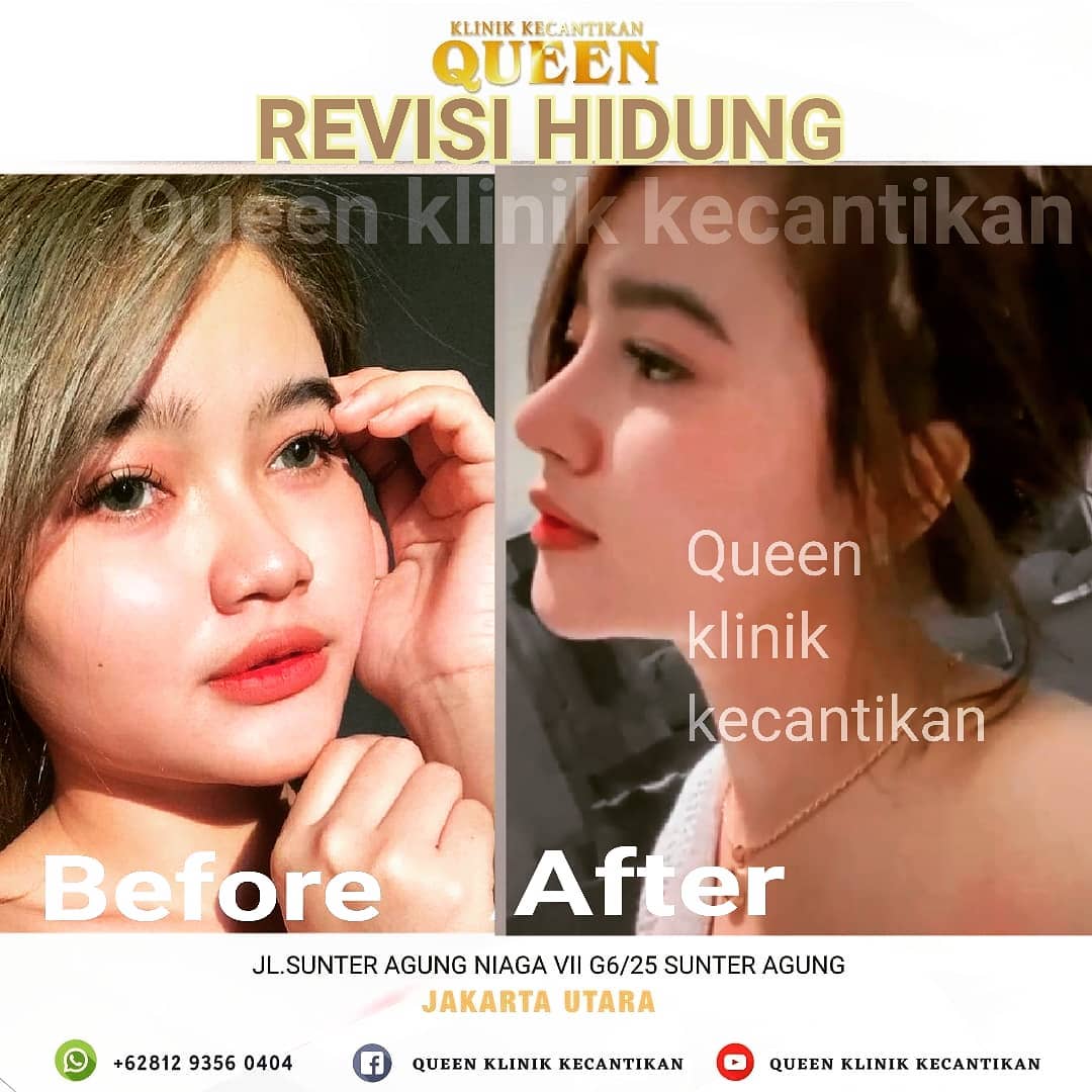 Hasil Rhinoplasty Queen Plastic Surgery, foto 49