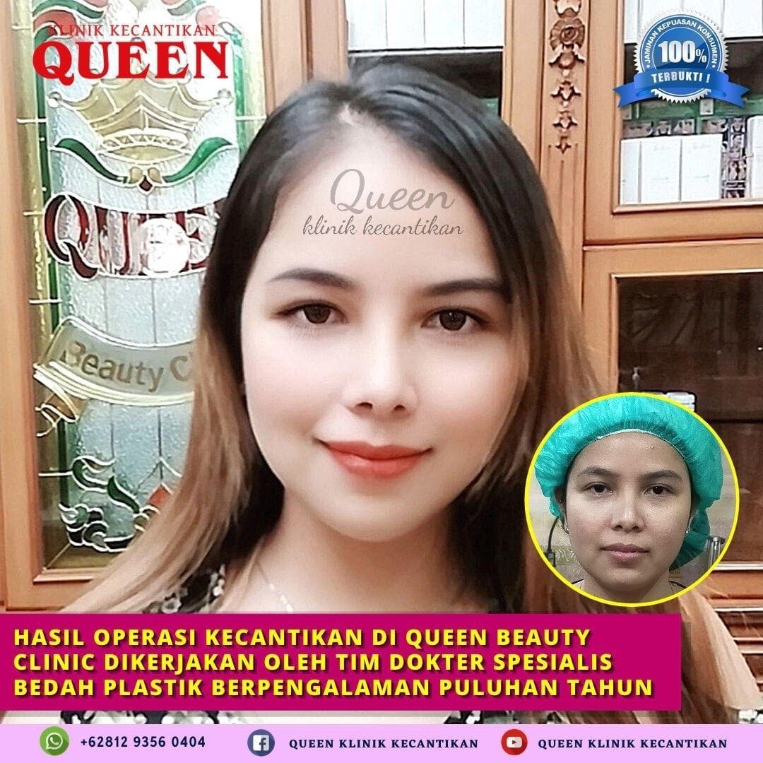 Hasil Rhinoplasty Queen Plastic Surgery, foto 58