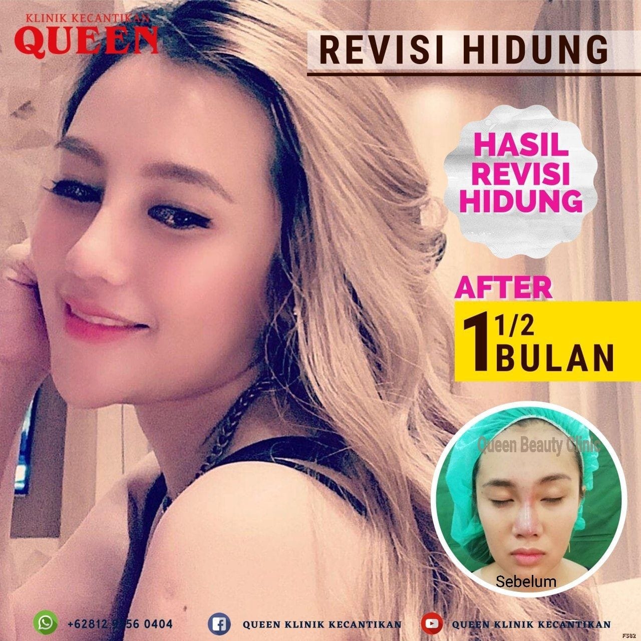 Hasil Rhinoplasty Queen Plastic Surgery, foto 57