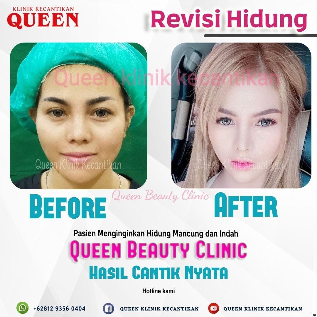 Hasil Rhinoplasty Queen Plastic Surgery, foto 67