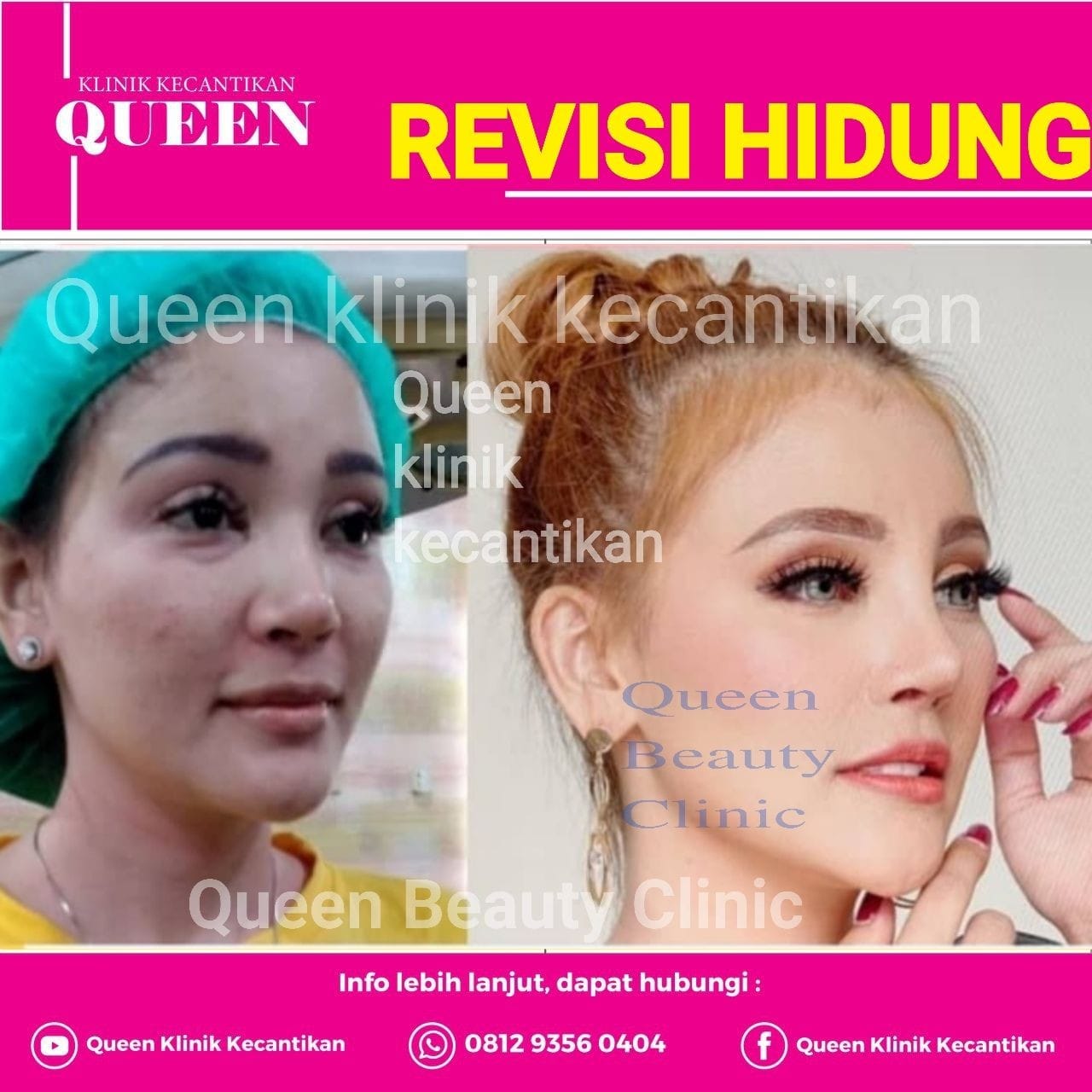 Hasil Rhinoplasty Queen Plastic Surgery, foto 66