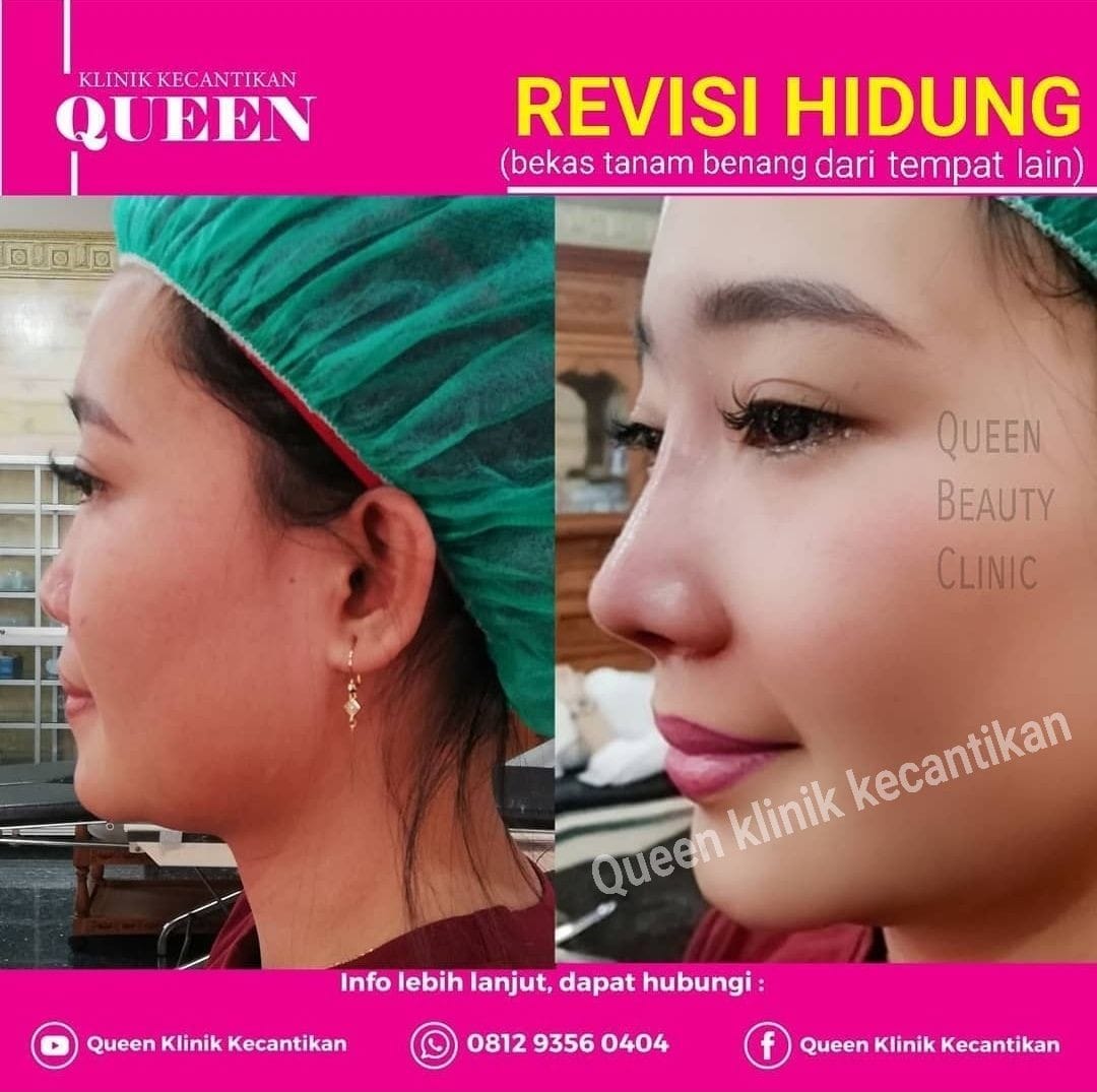 Hasil Rhinoplasty Queen Plastic Surgery, foto 65