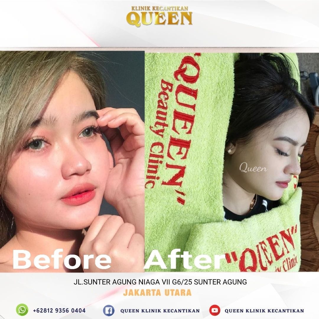 Hasil Rhinoplasty Queen Plastic Surgery, foto 72