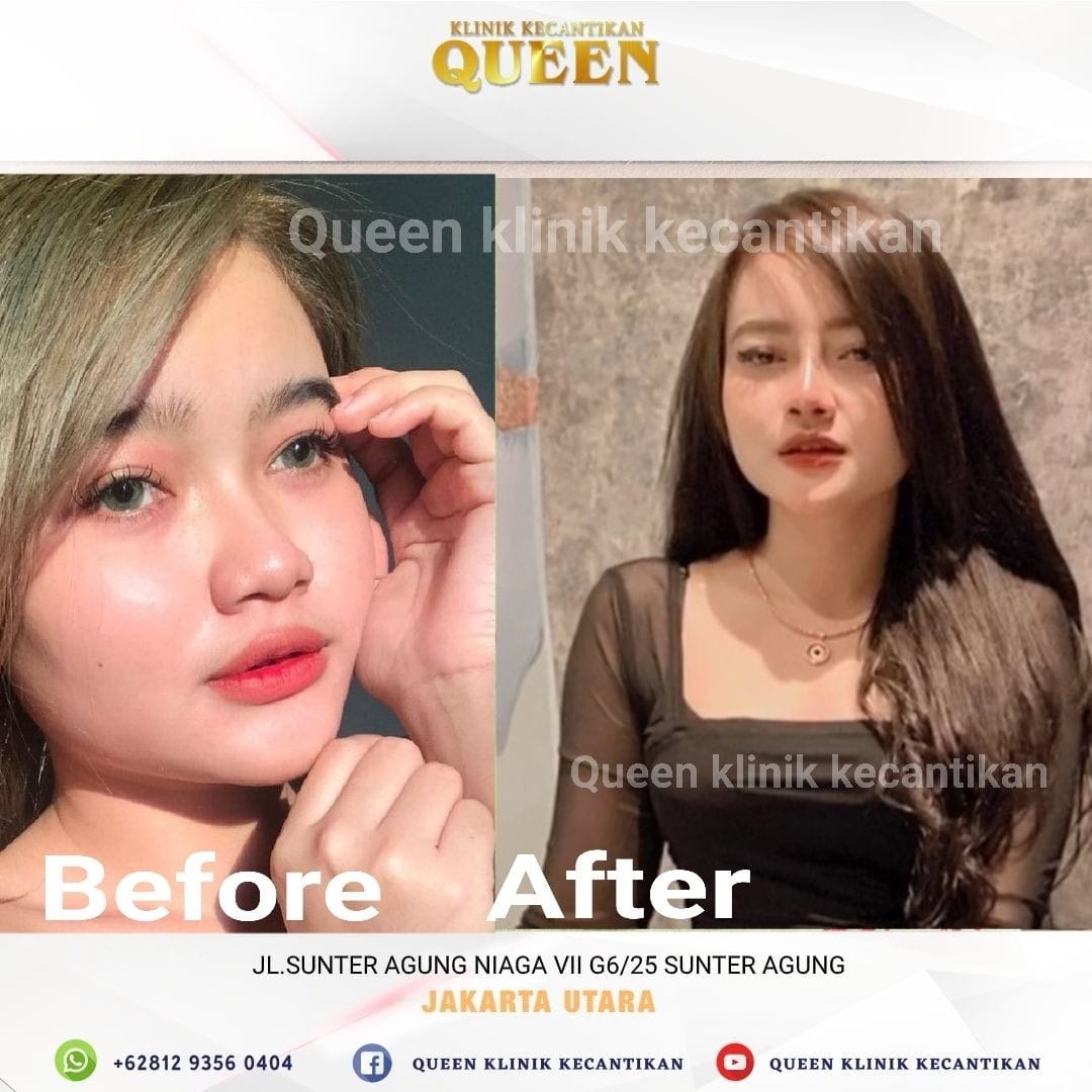 Hasil Rhinoplasty Queen Plastic Surgery, foto 71