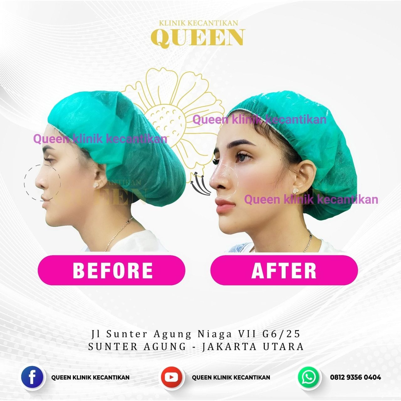 Hasil Rhinoplasty Queen Plastic Surgery, foto 70