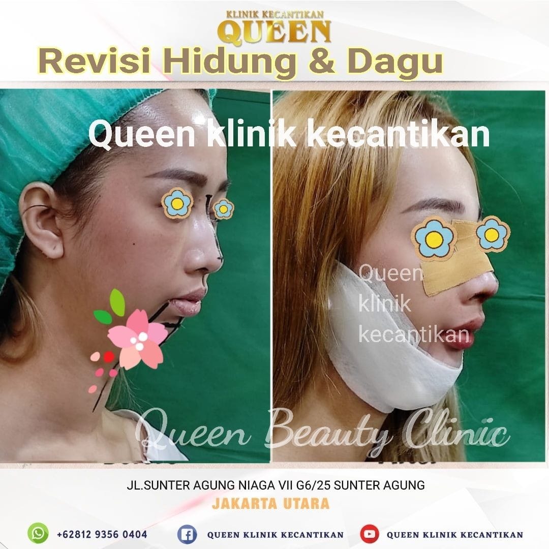 Hasil Rhinoplasty Queen Plastic Surgery, foto 79