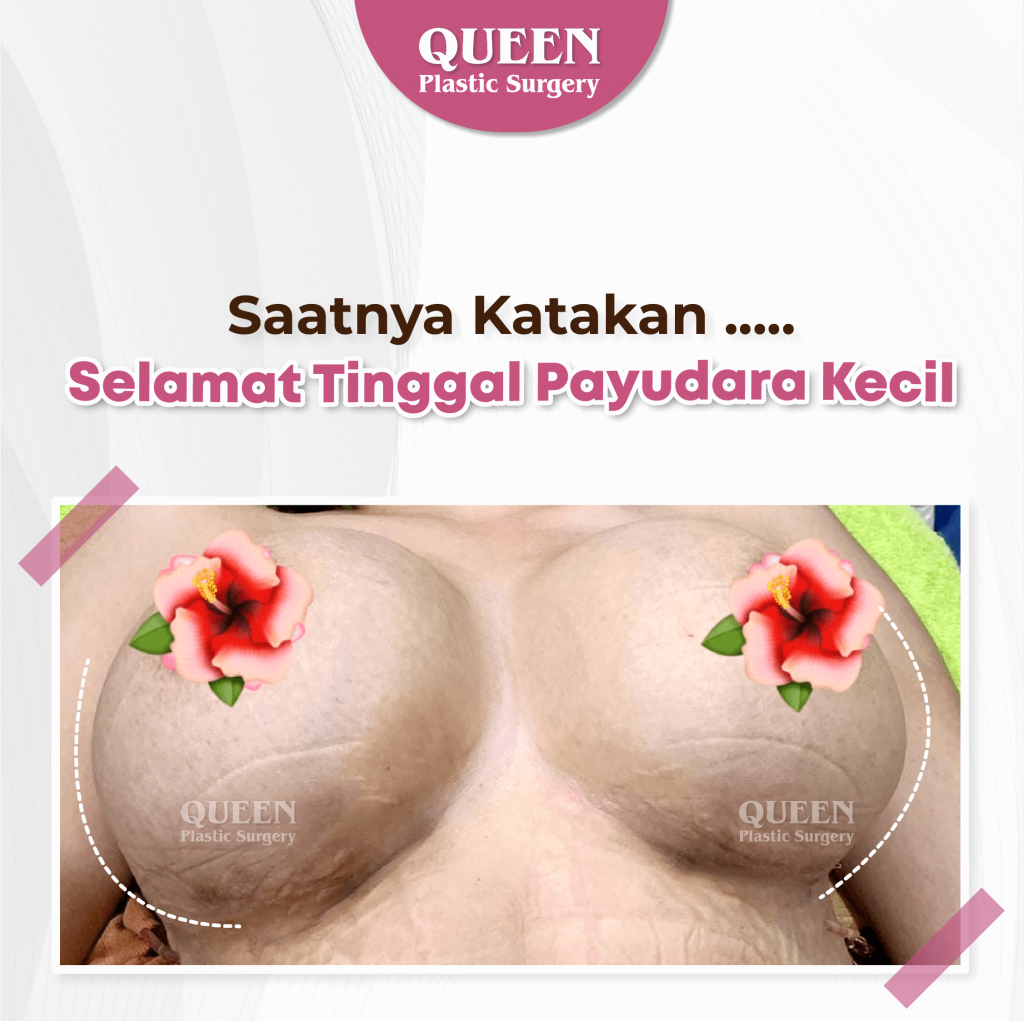 Hasil Breast Implant Queen Plastic Surgery, foto 30