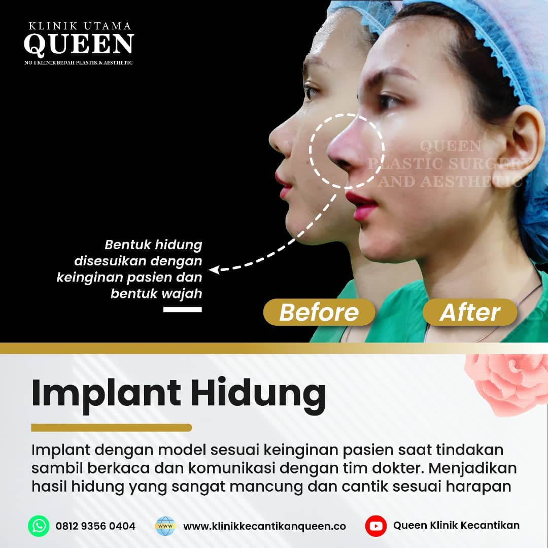 Hasil Rhinoplasty Queen Plastic Surgery, foto 45