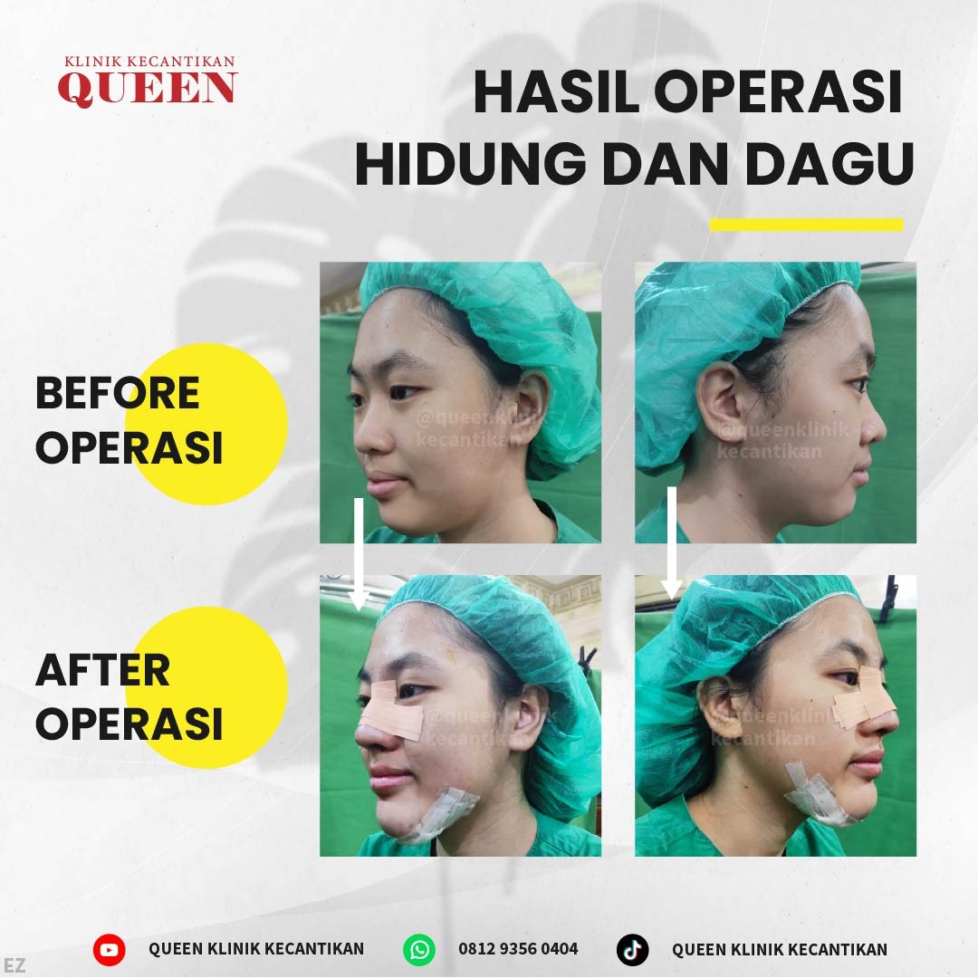 https://queenplasticsurgery.id/wp-content/uploads/2024/01/3-09.jpg