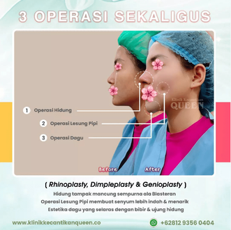 APA YANG TERJADI SELAMA PEMULIHAN DIMPLEPLASTY ? APA YANG TERJADI SELAMA PEMULIHAN DIMPLEPLASTY ?