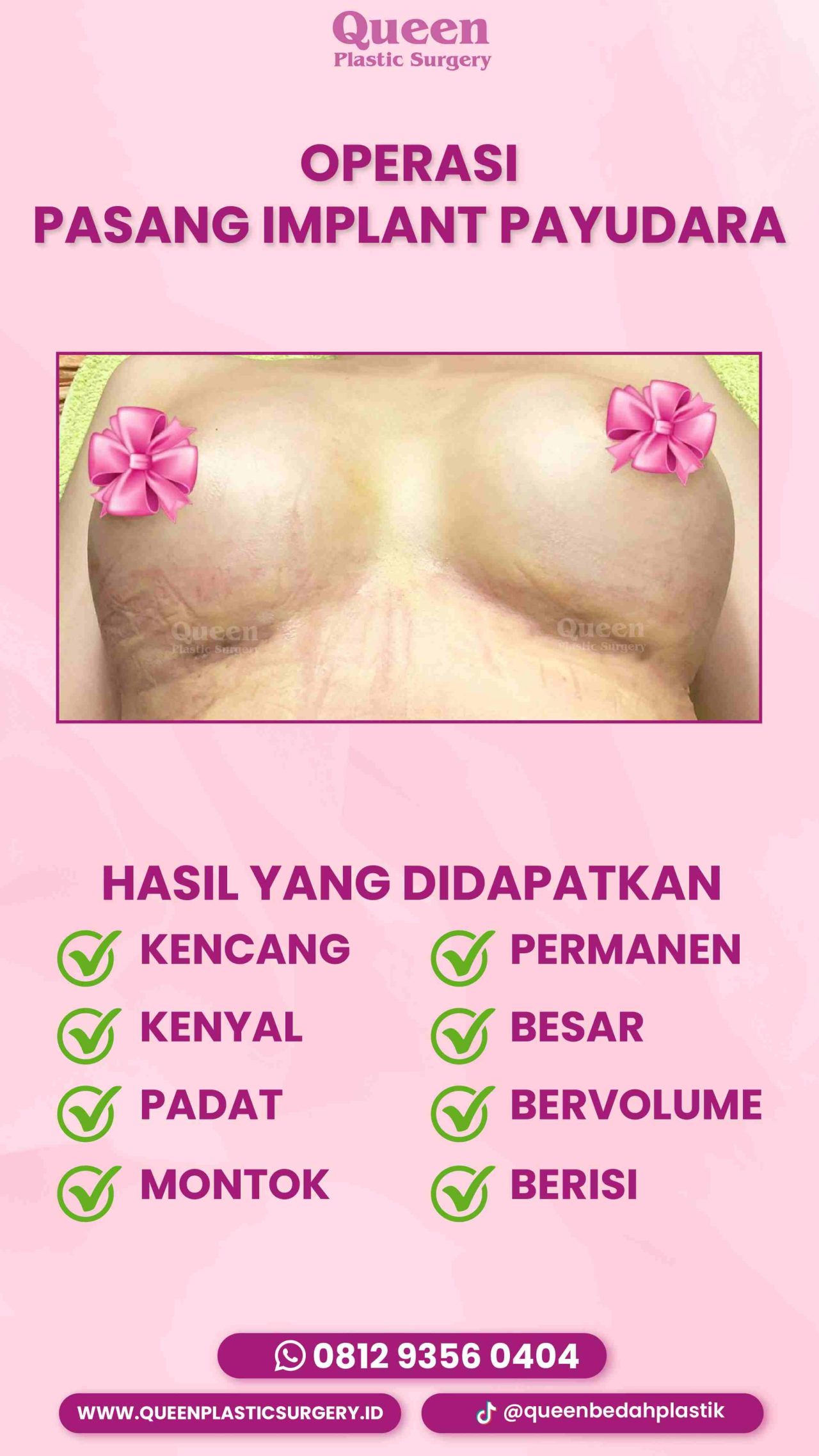 Hasil Breast Implant Queen Plastic Surgery, foto 25