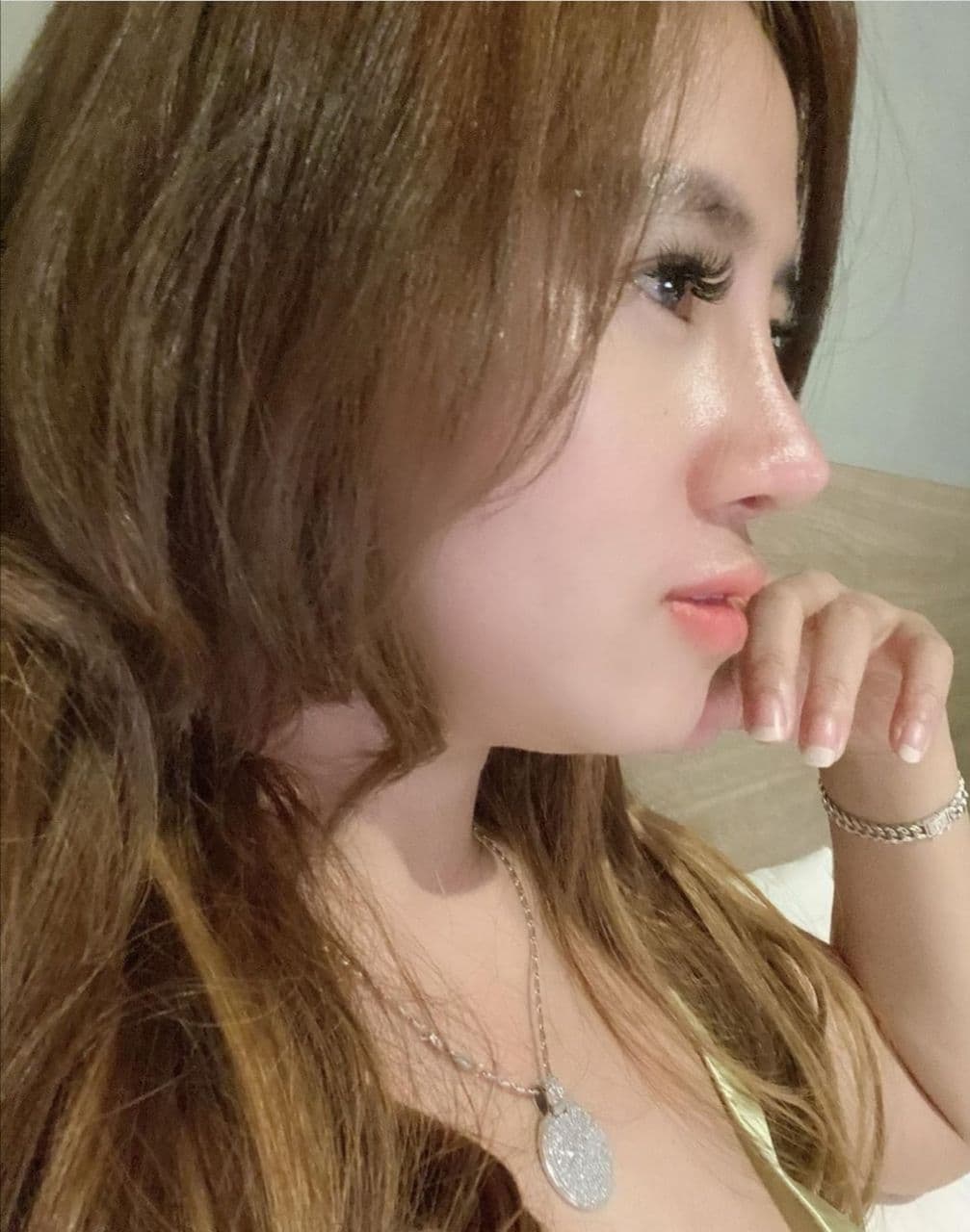 Hasil Rhinoplasty Queen Plastic Surgery, foto 17