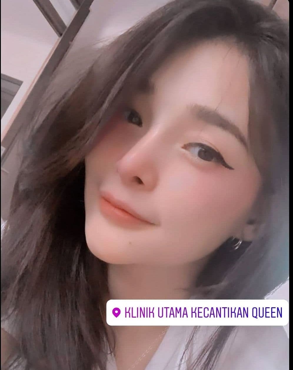 Hasil Rhinoplasty Queen Plastic Surgery, foto 13