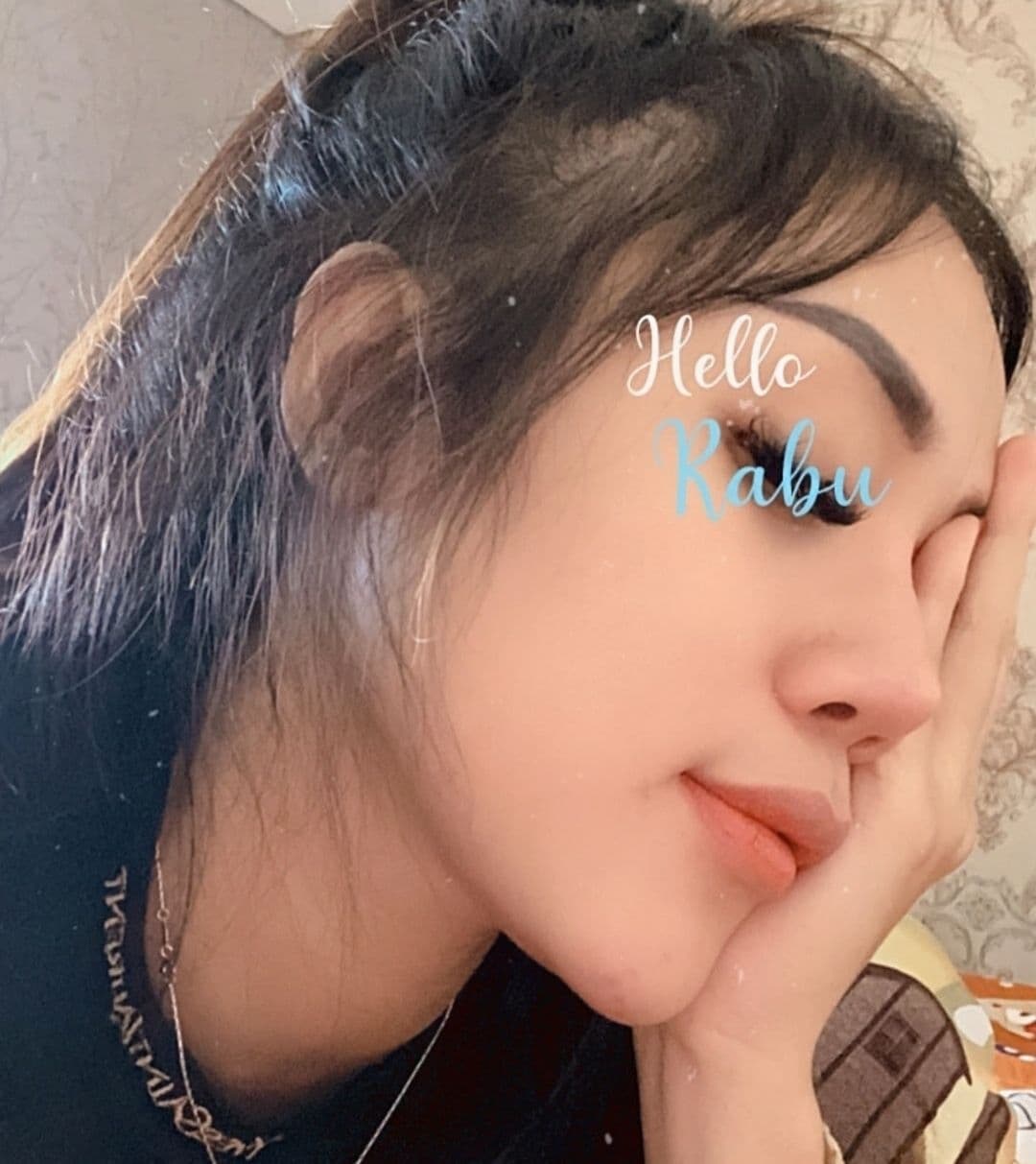 Hasil Rhinoplasty Queen Plastic Surgery, foto 23
