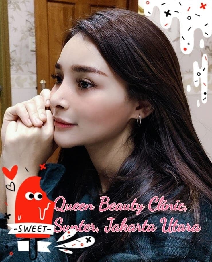 Hasil Rhinoplasty Queen Plastic Surgery, foto 28