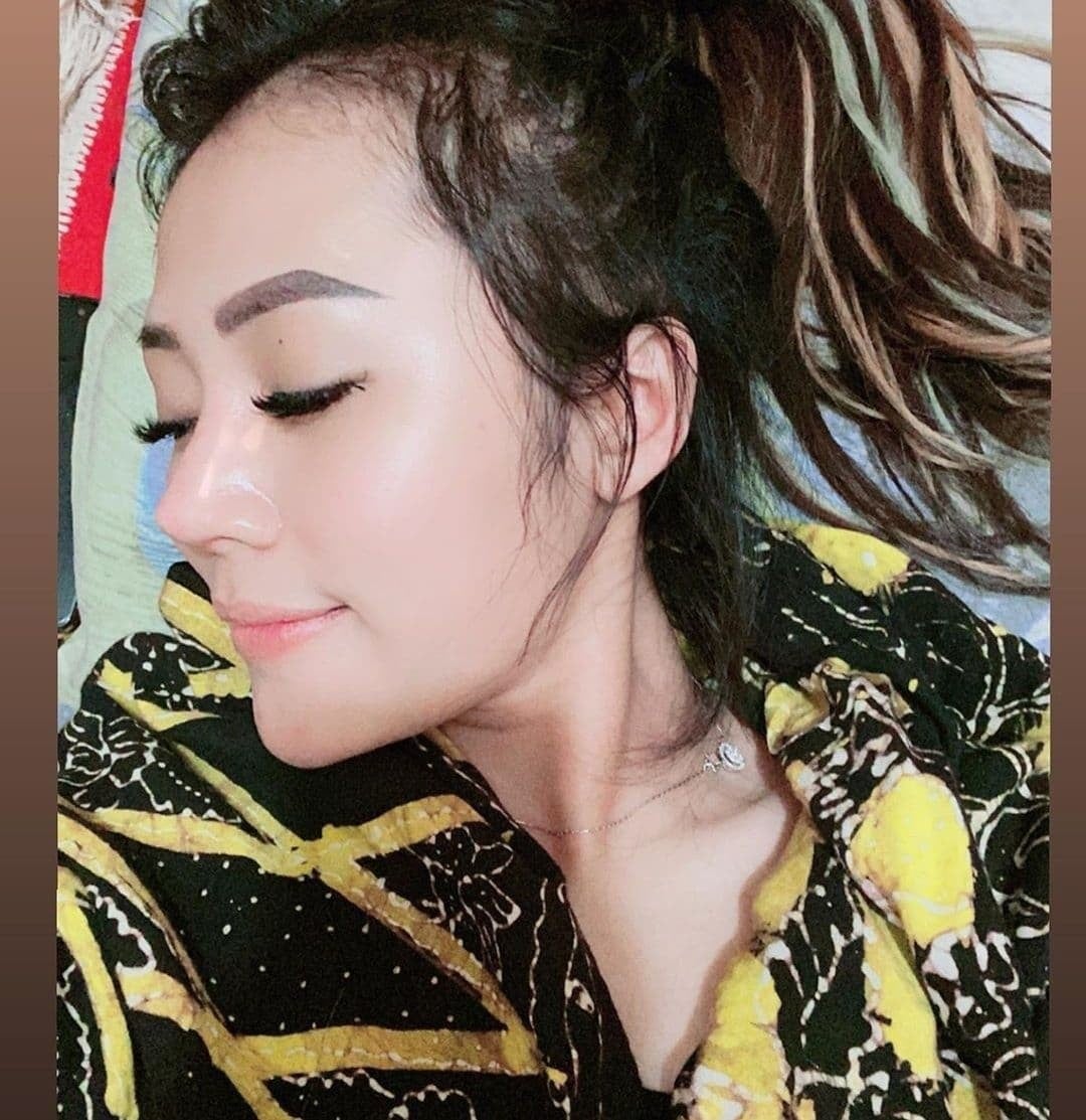 Hasil Rhinoplasty Queen Plastic Surgery, foto 27