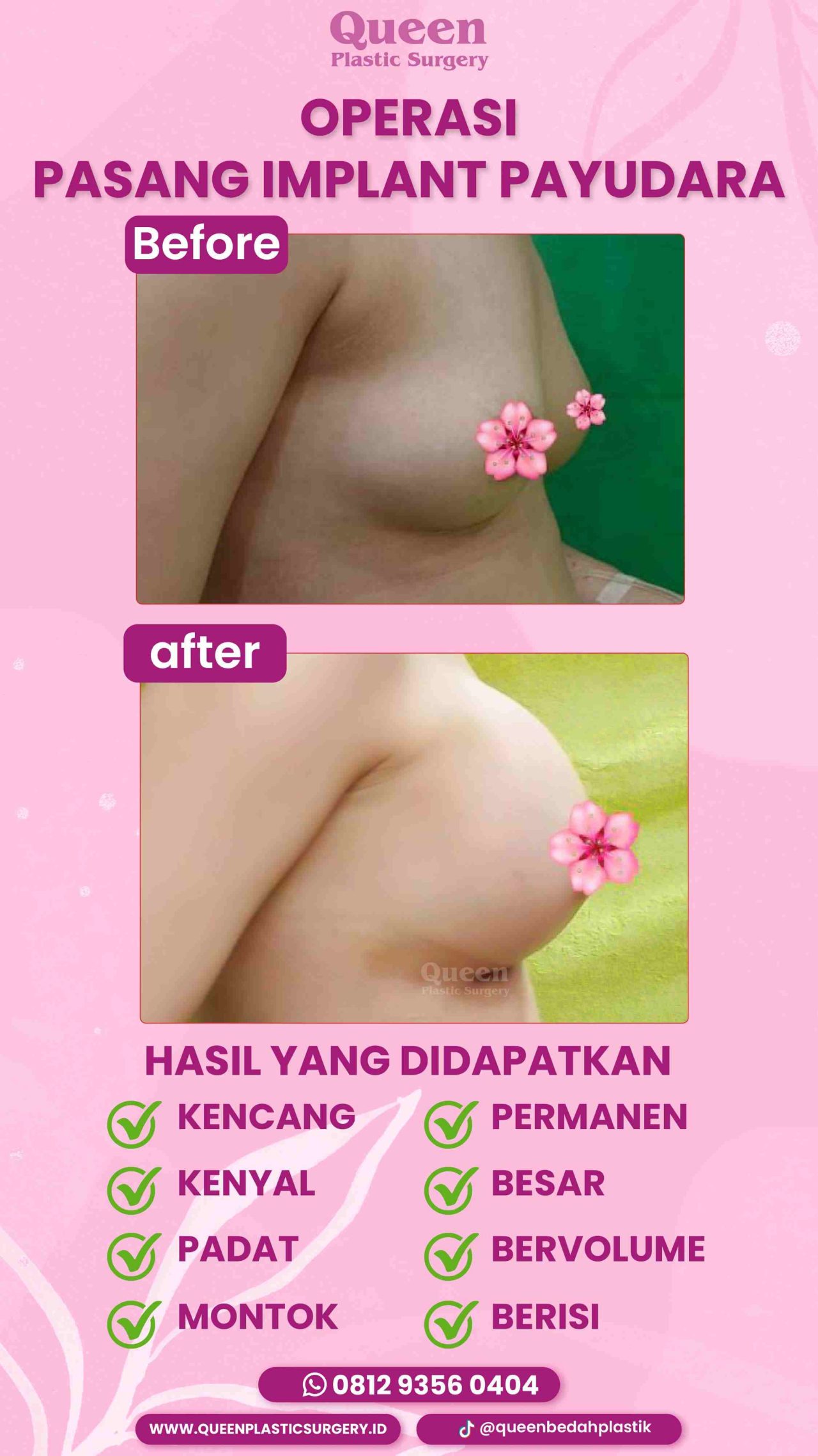 Hasil Breast Implant Queen Plastic Surgery, foto 39