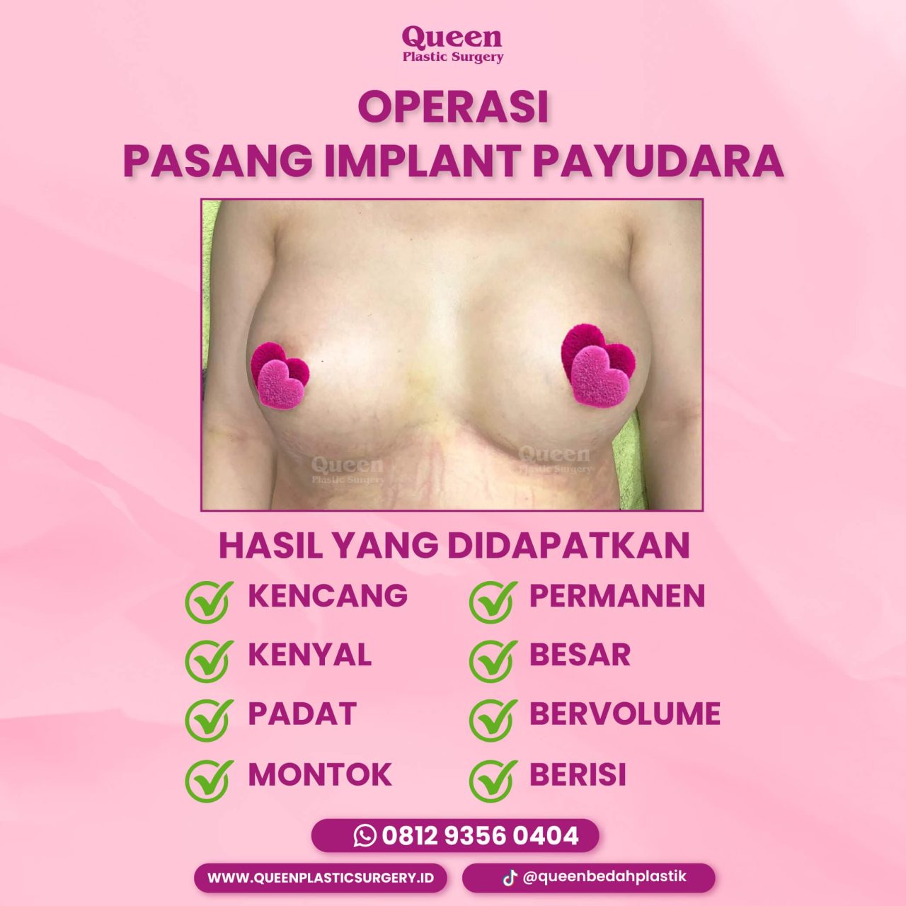 Hasil Breast Implant Queen Plastic Surgery, foto 2