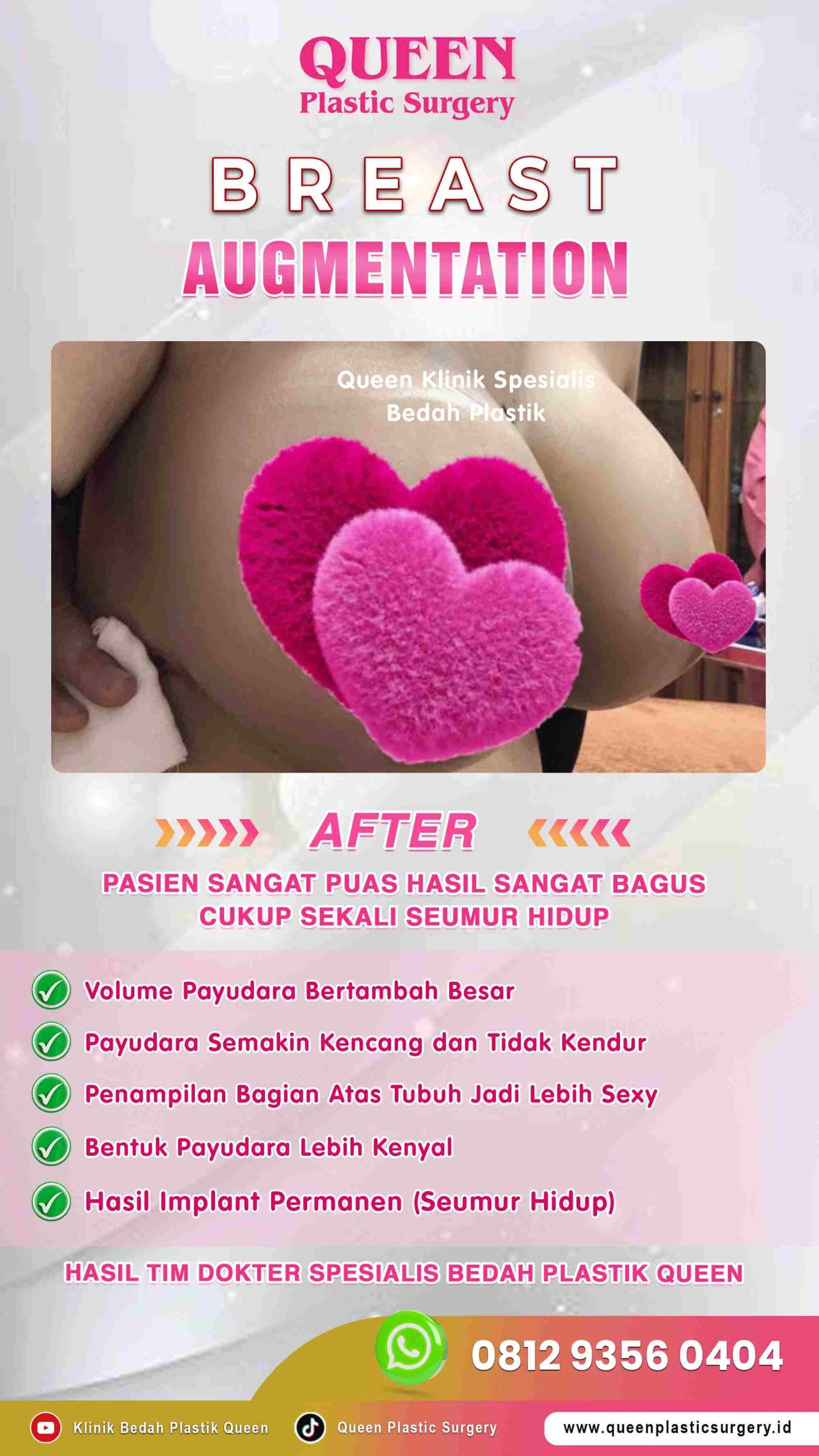 Hasil Breast Implant Queen Plastic Surgery, foto 90