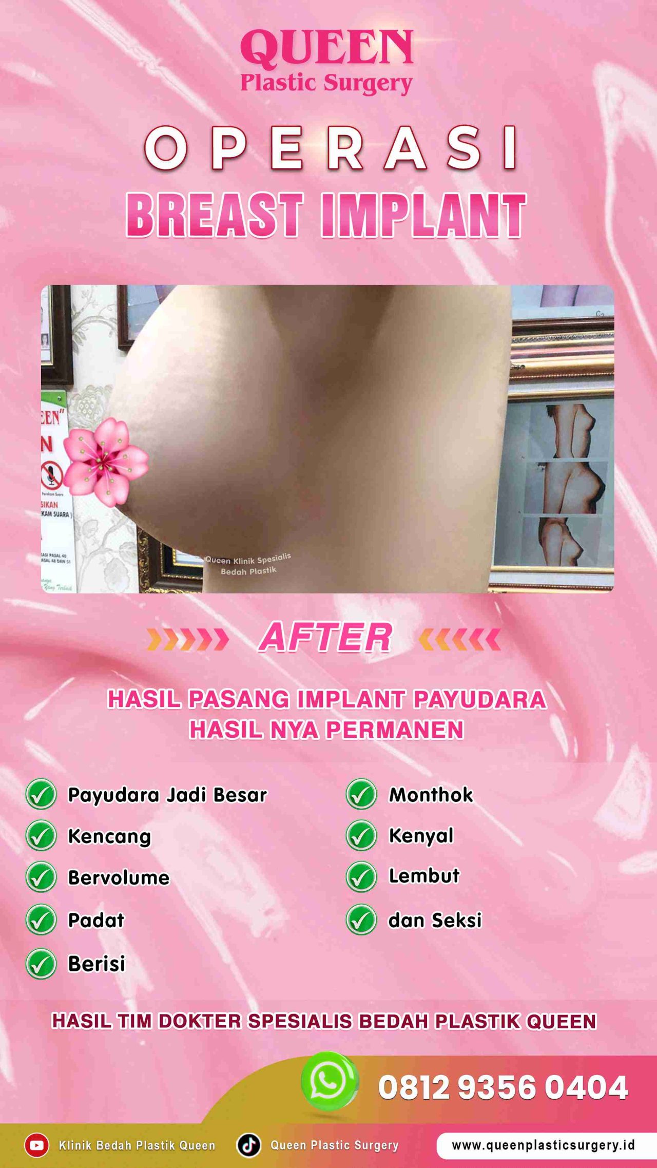 Hasil Breast Implant Queen Plastic Surgery, foto 56