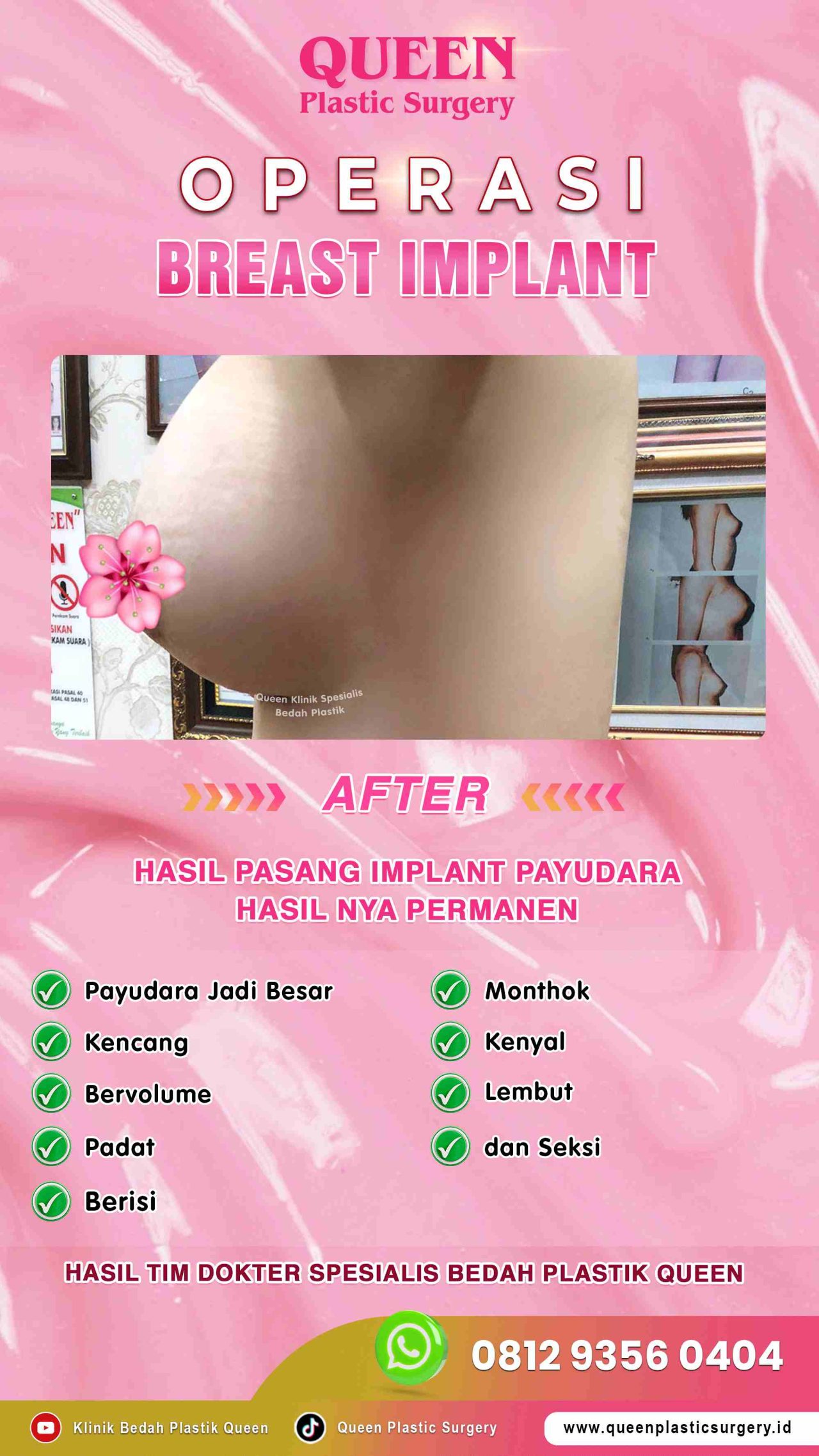 AFTER-Breast-Implant-Hasil-Memuaskan-003 (3) (1)-fotor-20240129162032