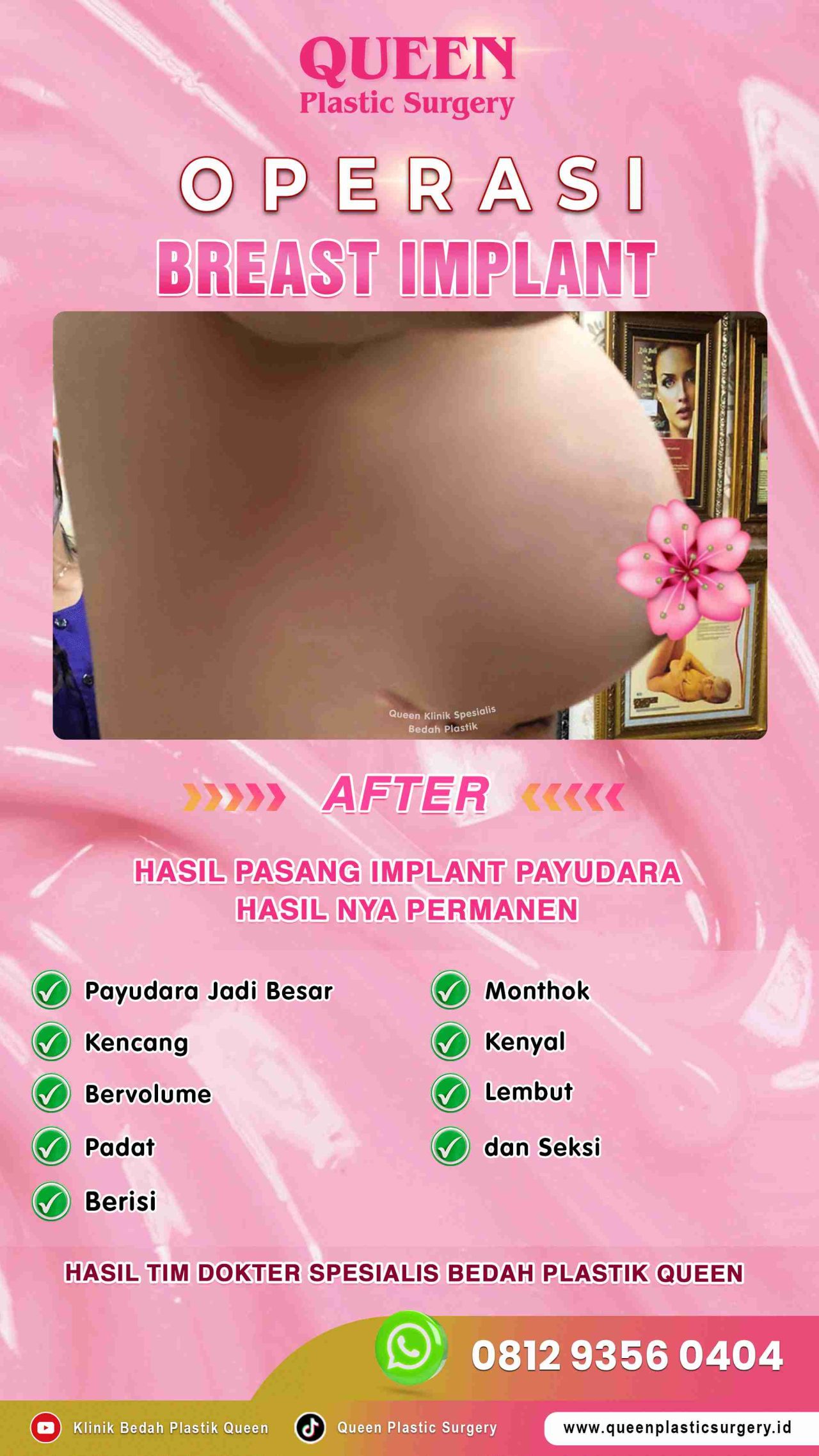 AFTER-Breast-Implant-Hasil-Memuaskan-004 (2) (1)-fotor-20240129161940