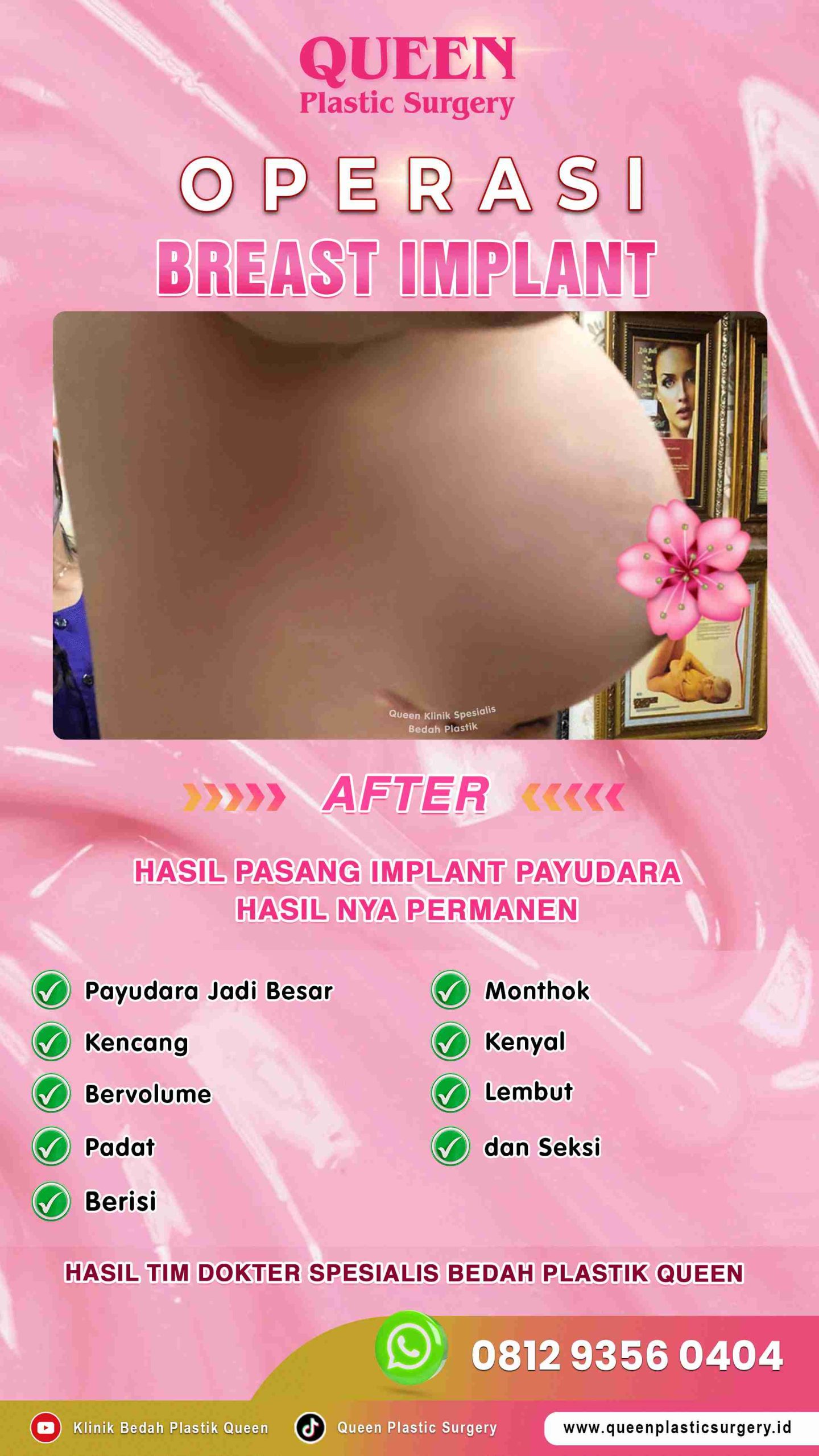 AFTER-Breast-Implant-Hasil-Memuaskan-004 (2) (1)-fotor-20240129161940