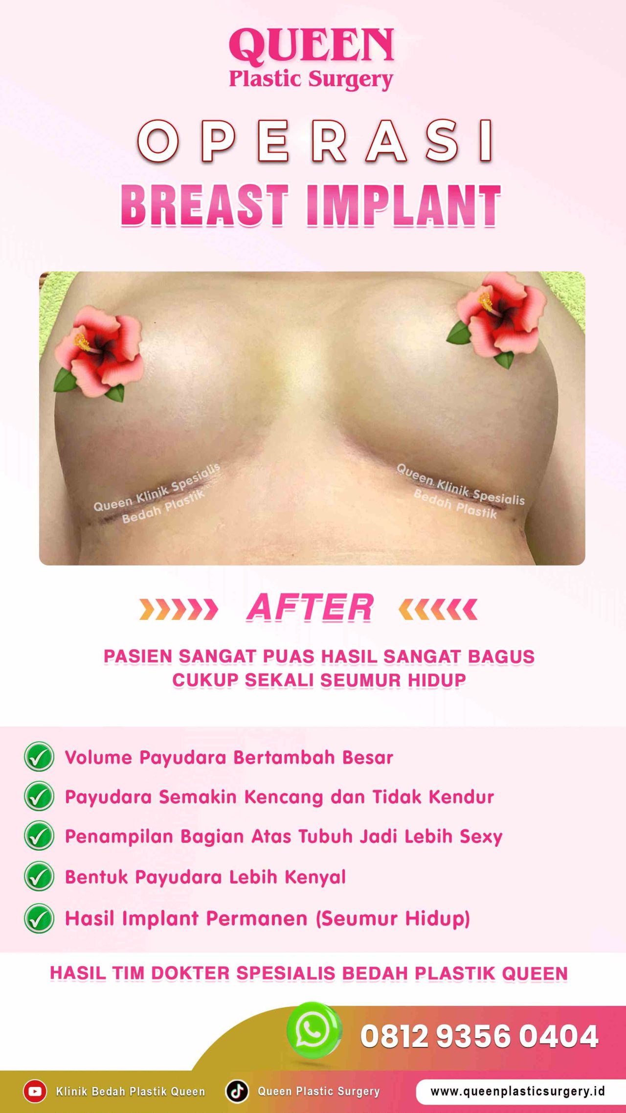 AFTER-Breast-Implant-Hasil-Memuaskan-004 (4) (1)-fotor-2024012916270