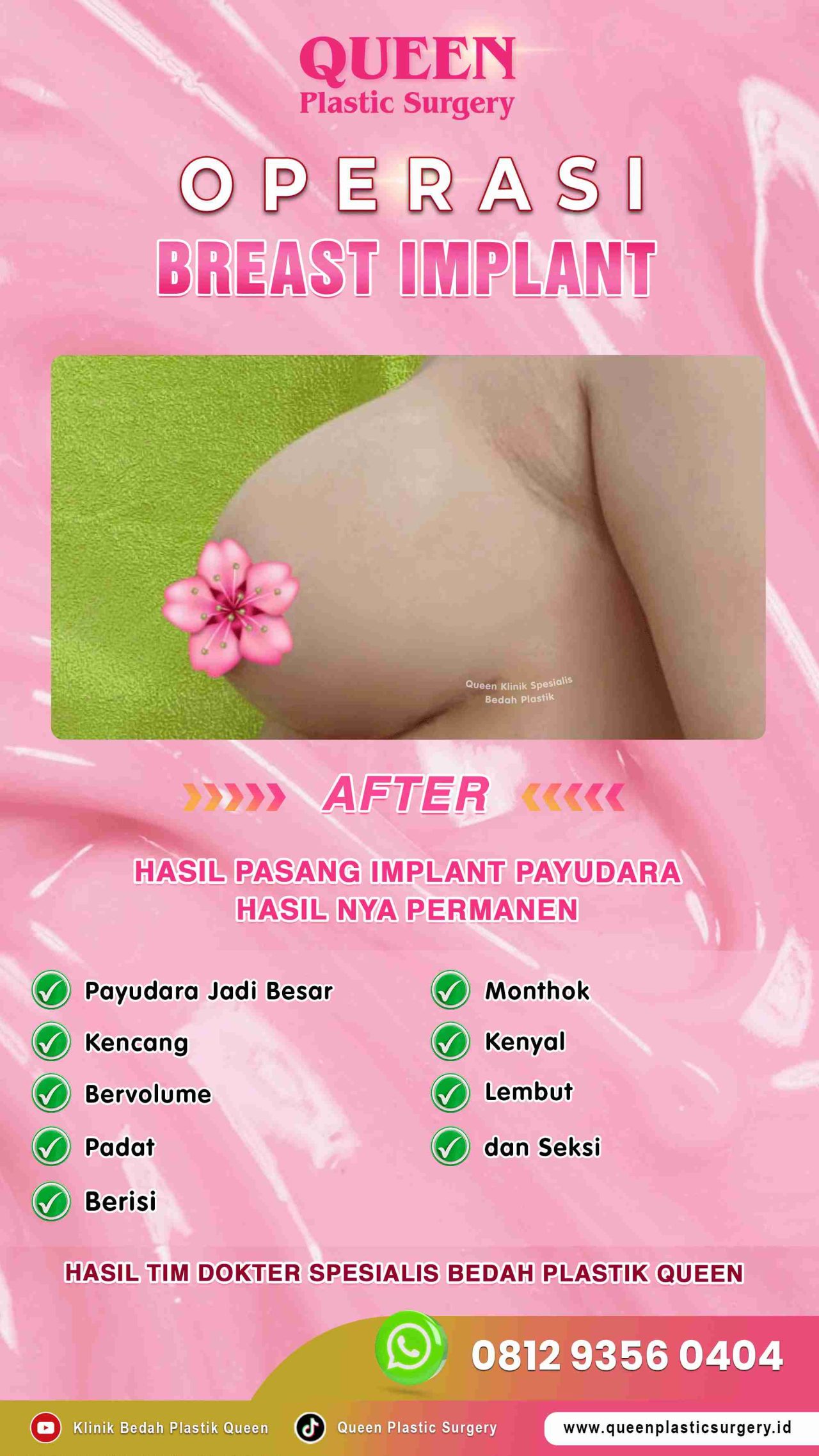 Hasil Breast Implant Queen Plastic Surgery, foto 48