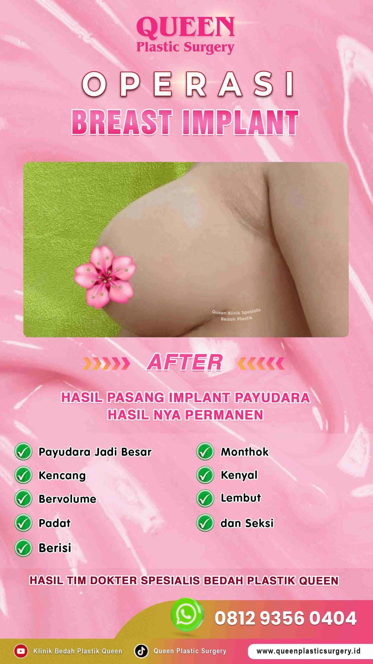 Hasil Breast Implant Queen Plastic Surgery, foto 41