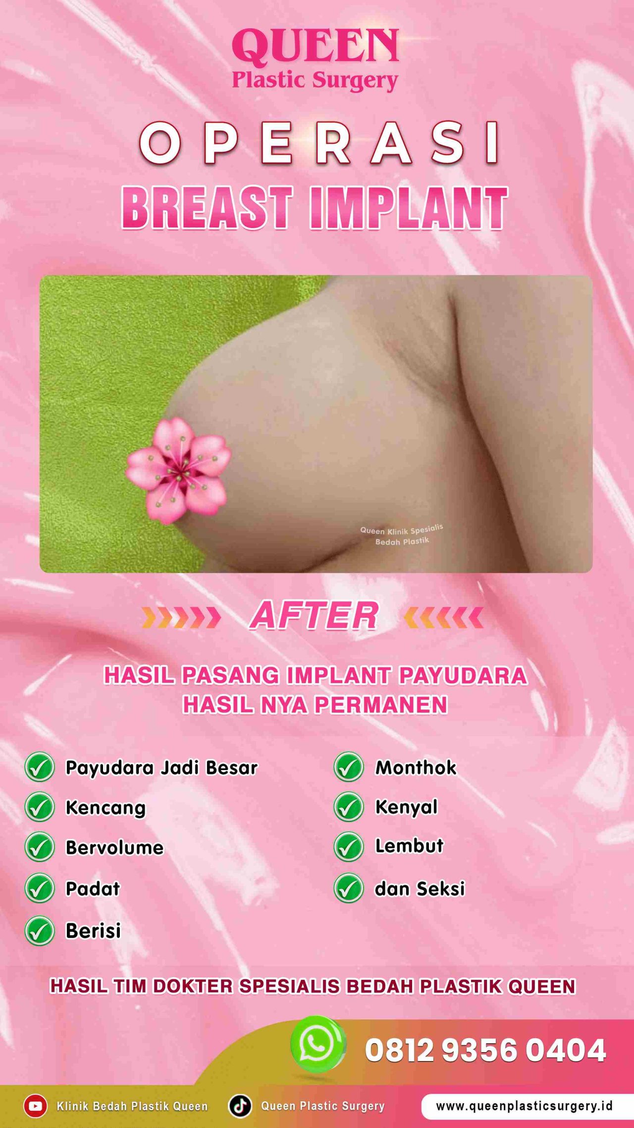 Hasil Breast Implant Queen Plastic Surgery, foto 42