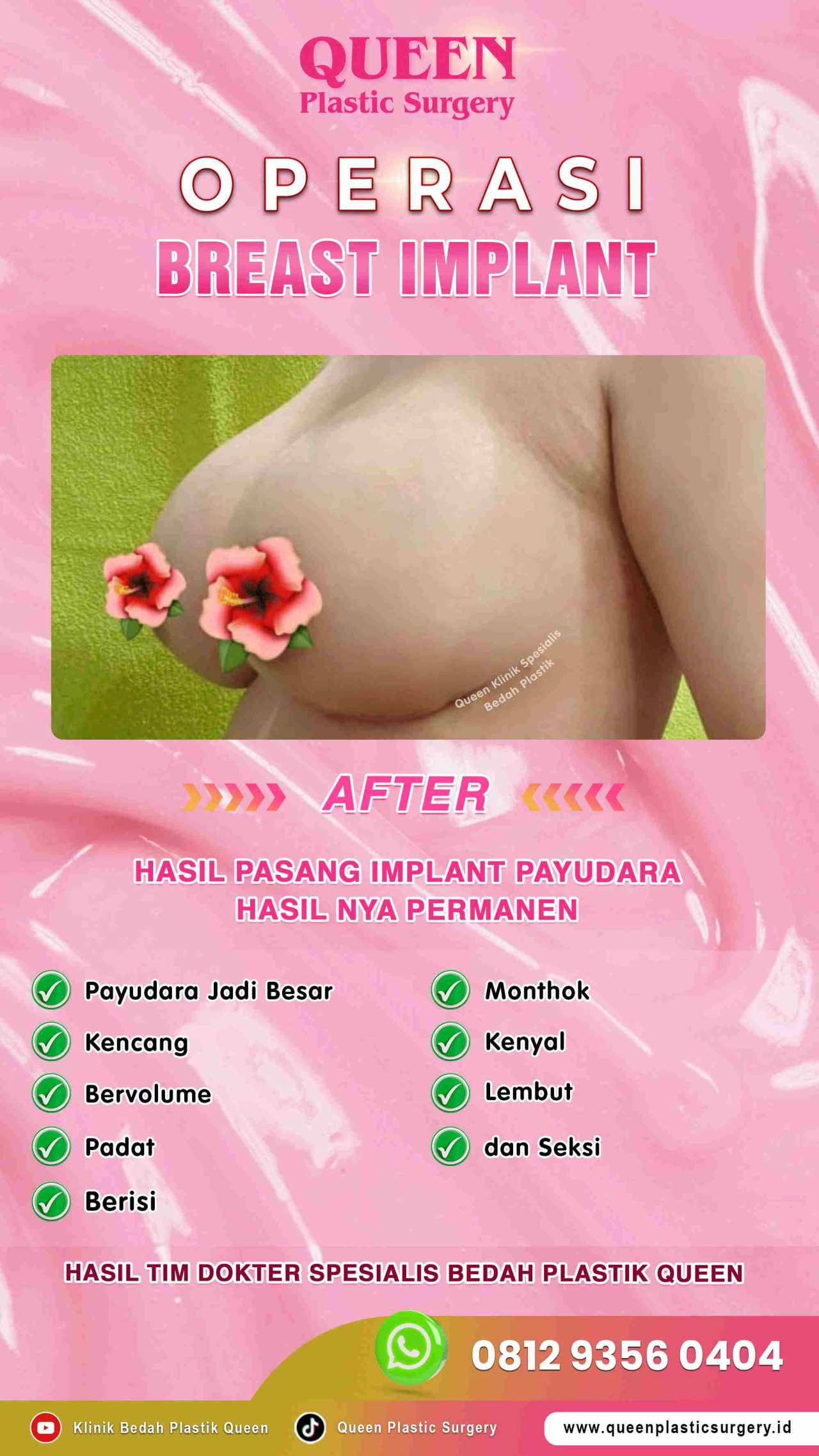 Hasil Breast Implant Queen Plastic Surgery, foto 44