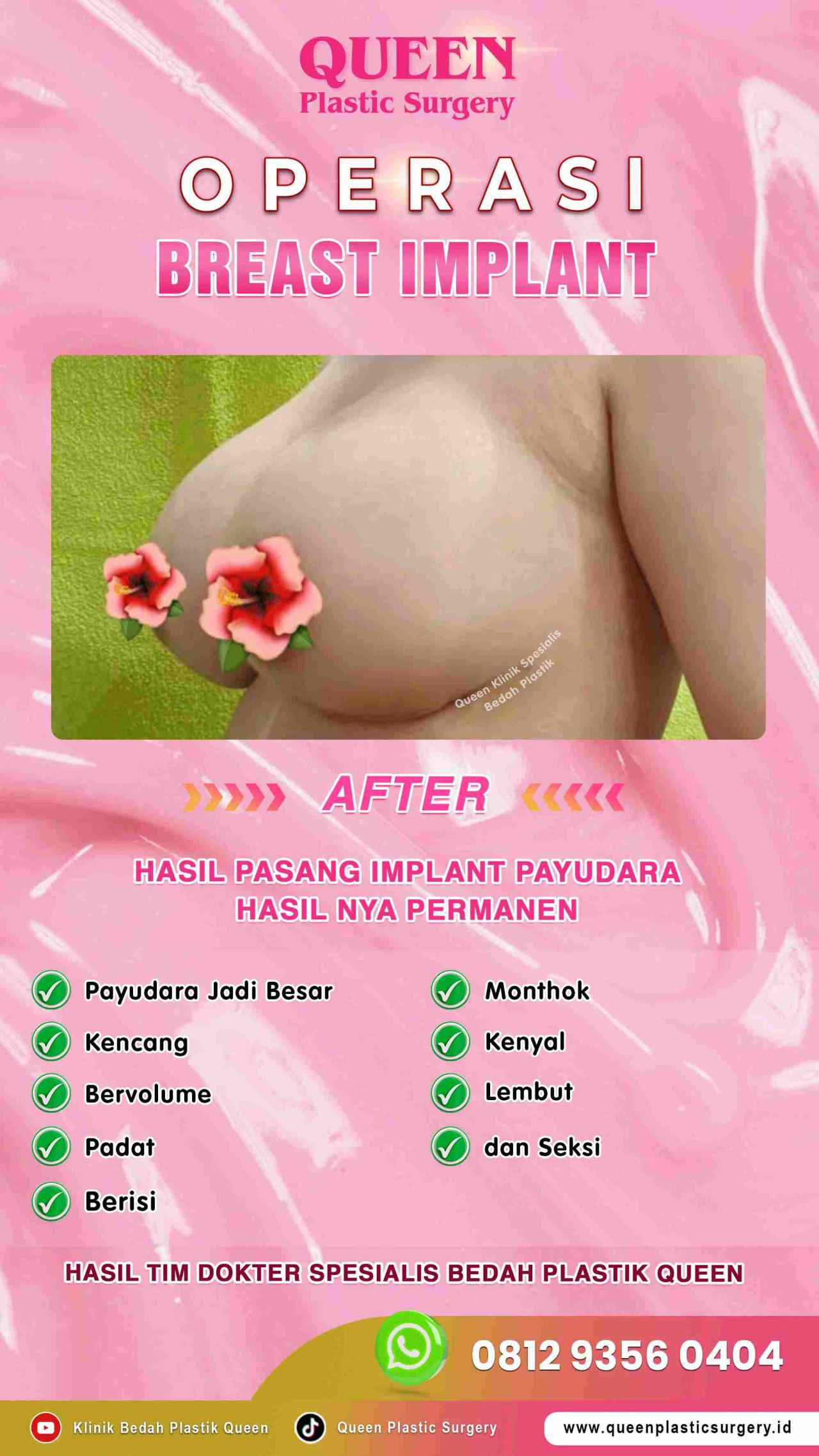 AFTER-Breast-Implant-Hasil-Memuaskan-006 (1) (1)-fotor-20240129172324