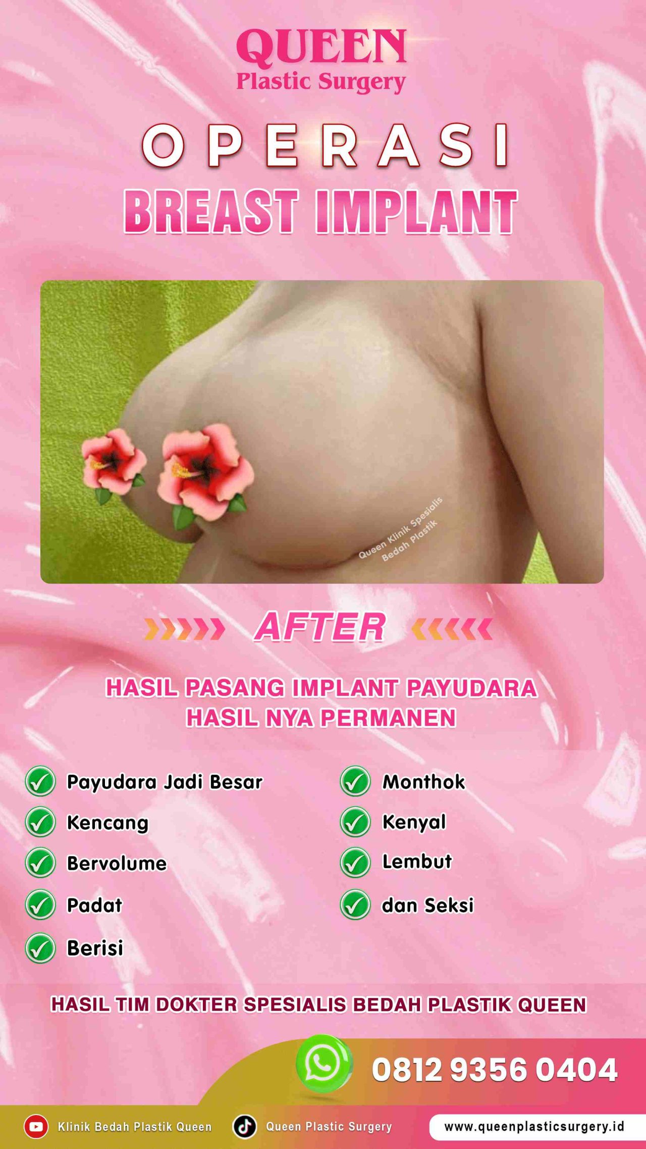 AFTER-Breast-Implant-Hasil-Memuaskan-006 (2)-fotor-2024012915258