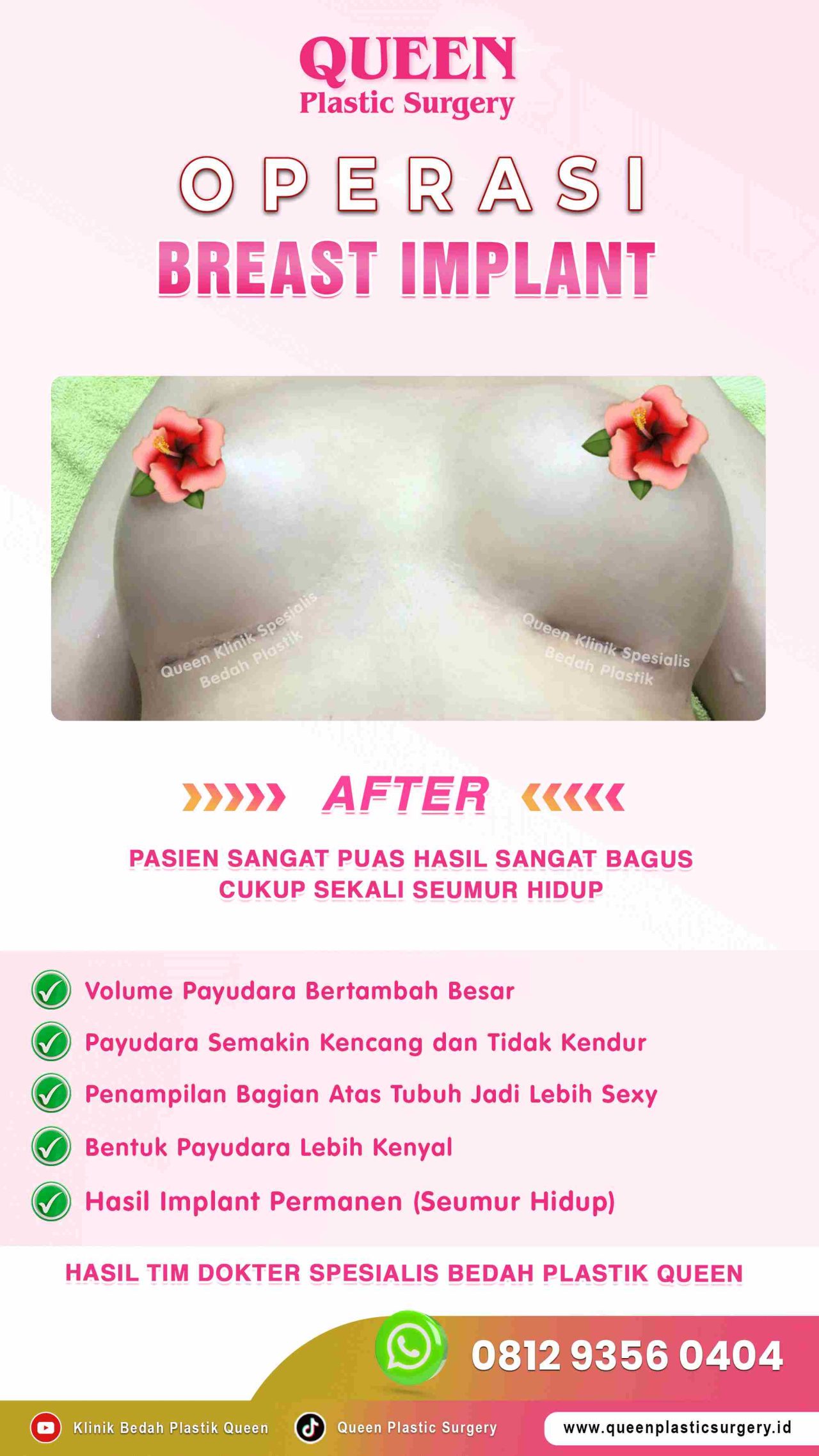 Hasil Breast Implant Queen Plastic Surgery, foto 16